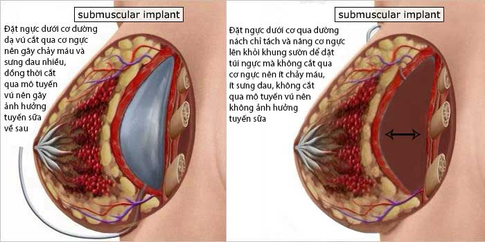 nâng ngực có nguy hiểm không