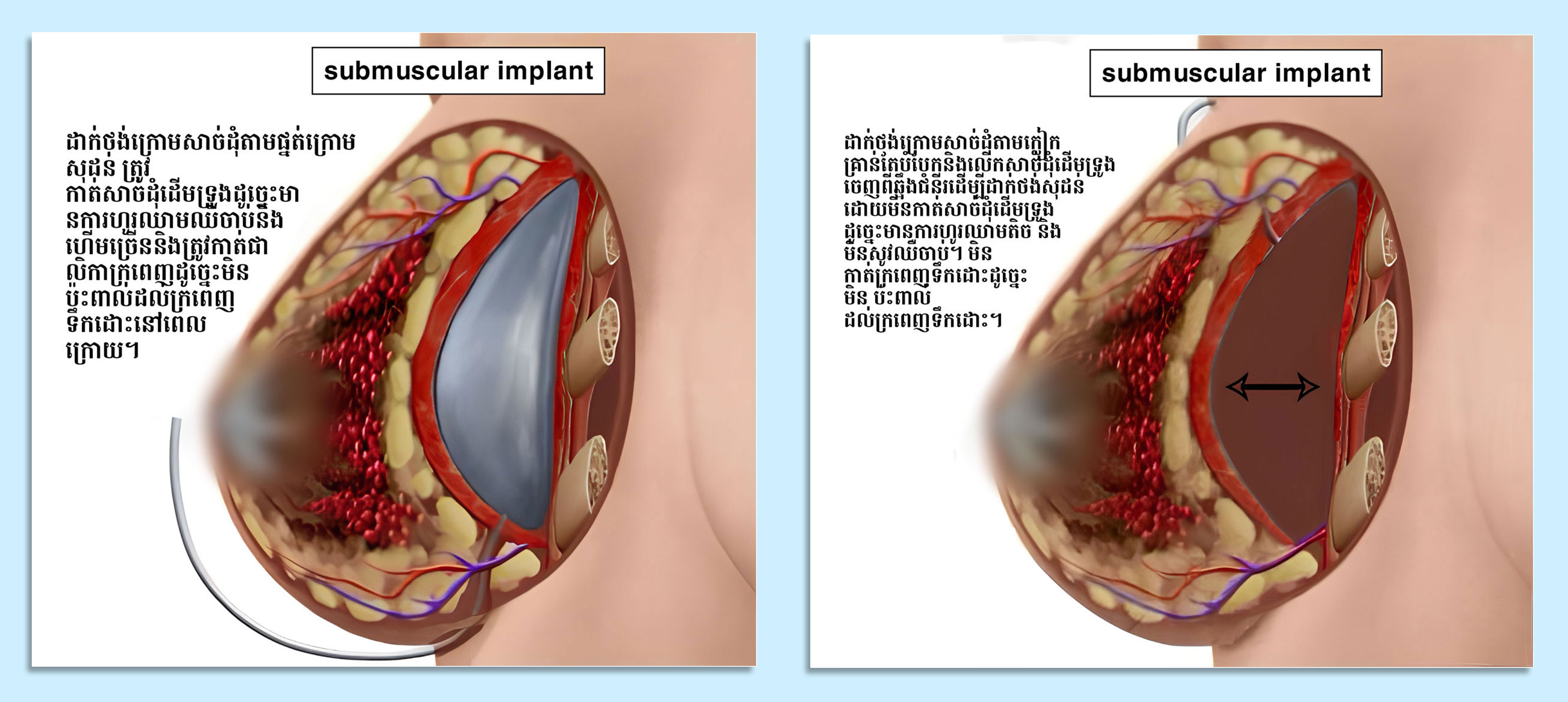 nâng ngực có nguy hiểm không