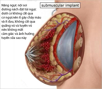 nâng ngực nội soi đặt dưới cơ