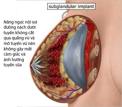 nâng ngực nội soi đặt dưới tuyến