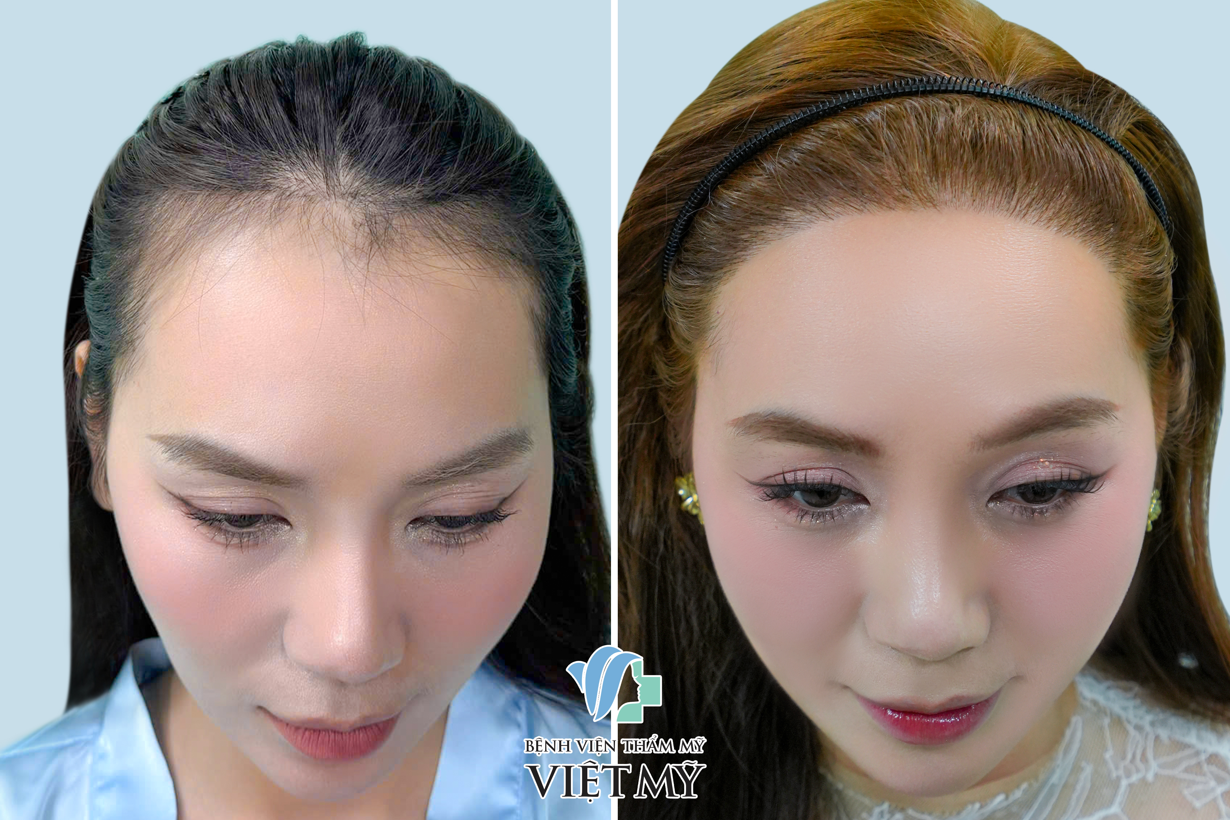 cấy tóc