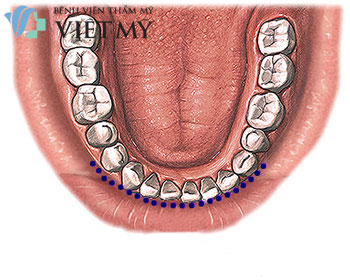vết mổ nâng cằm bên trong miệng