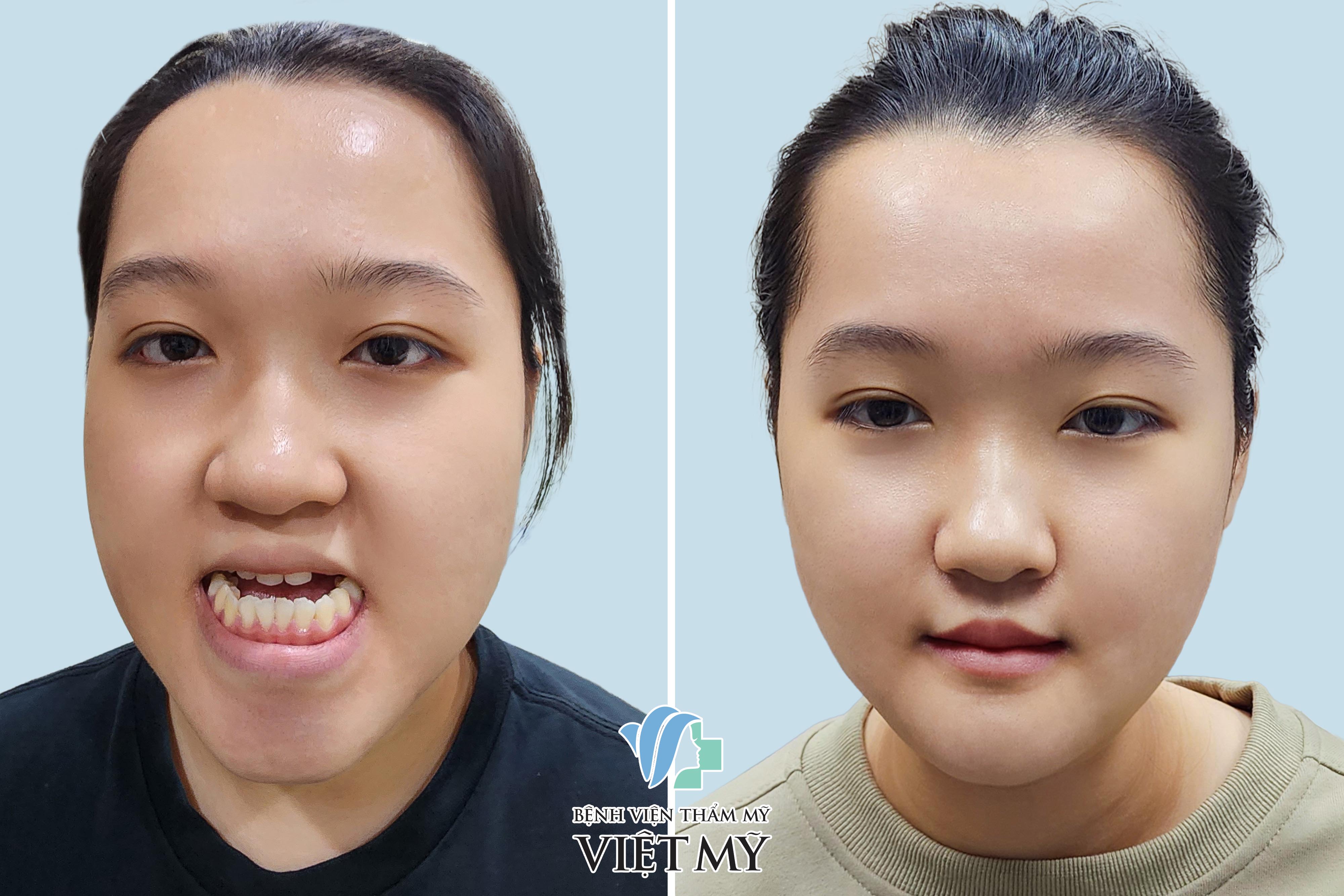 điều trị hàm móm