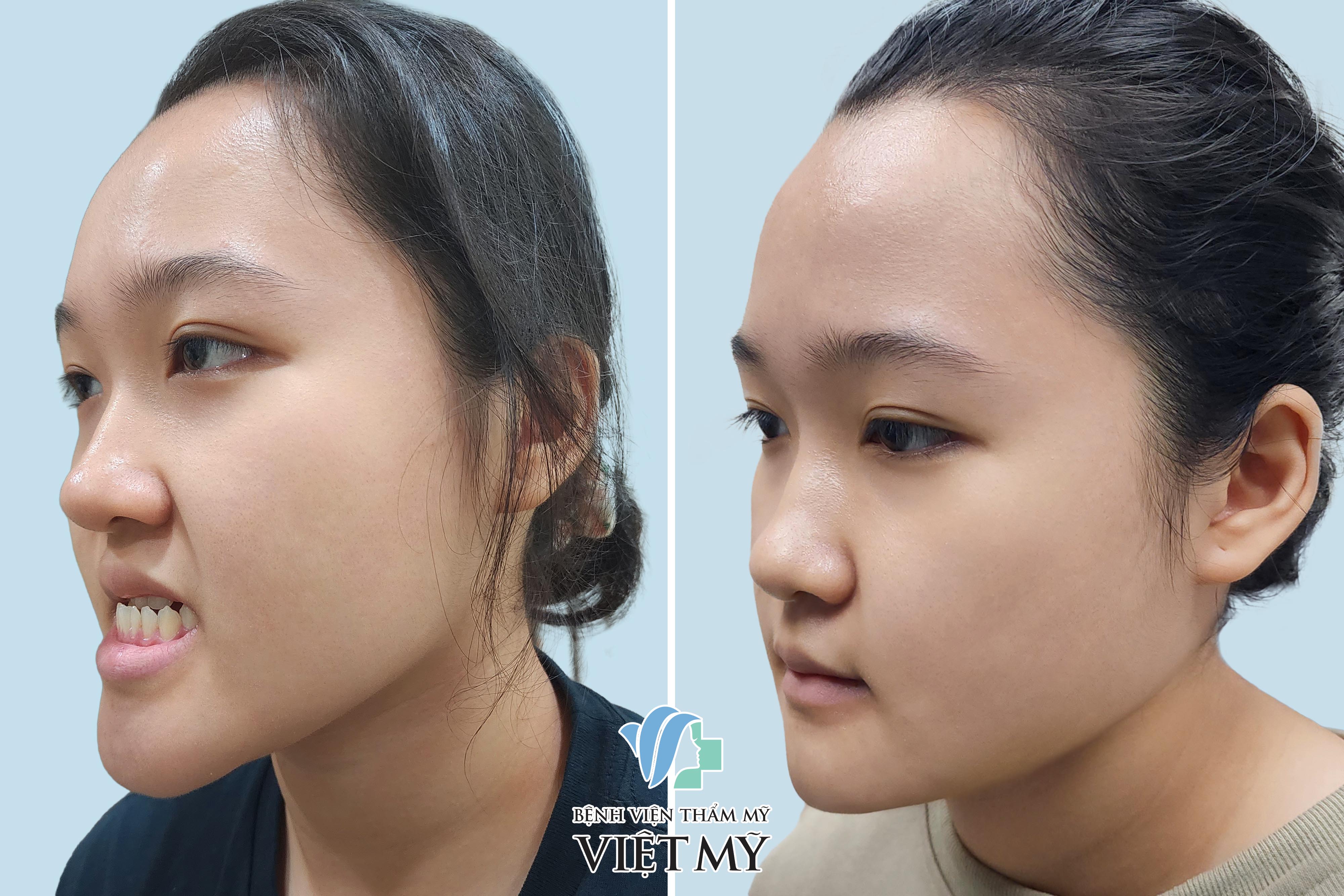 điều trị hàm móm