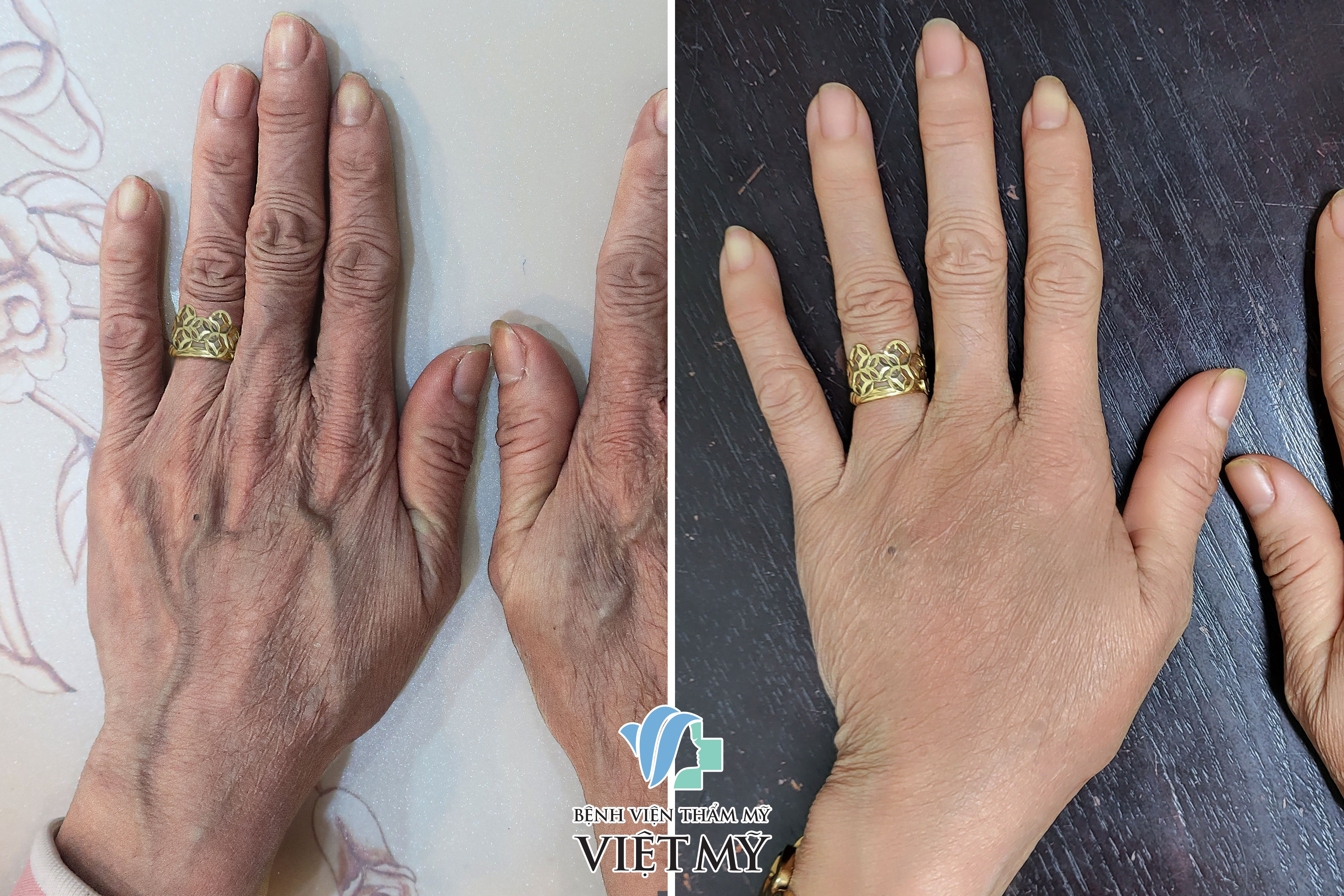 bơm mỡ làm đầy bàn tay