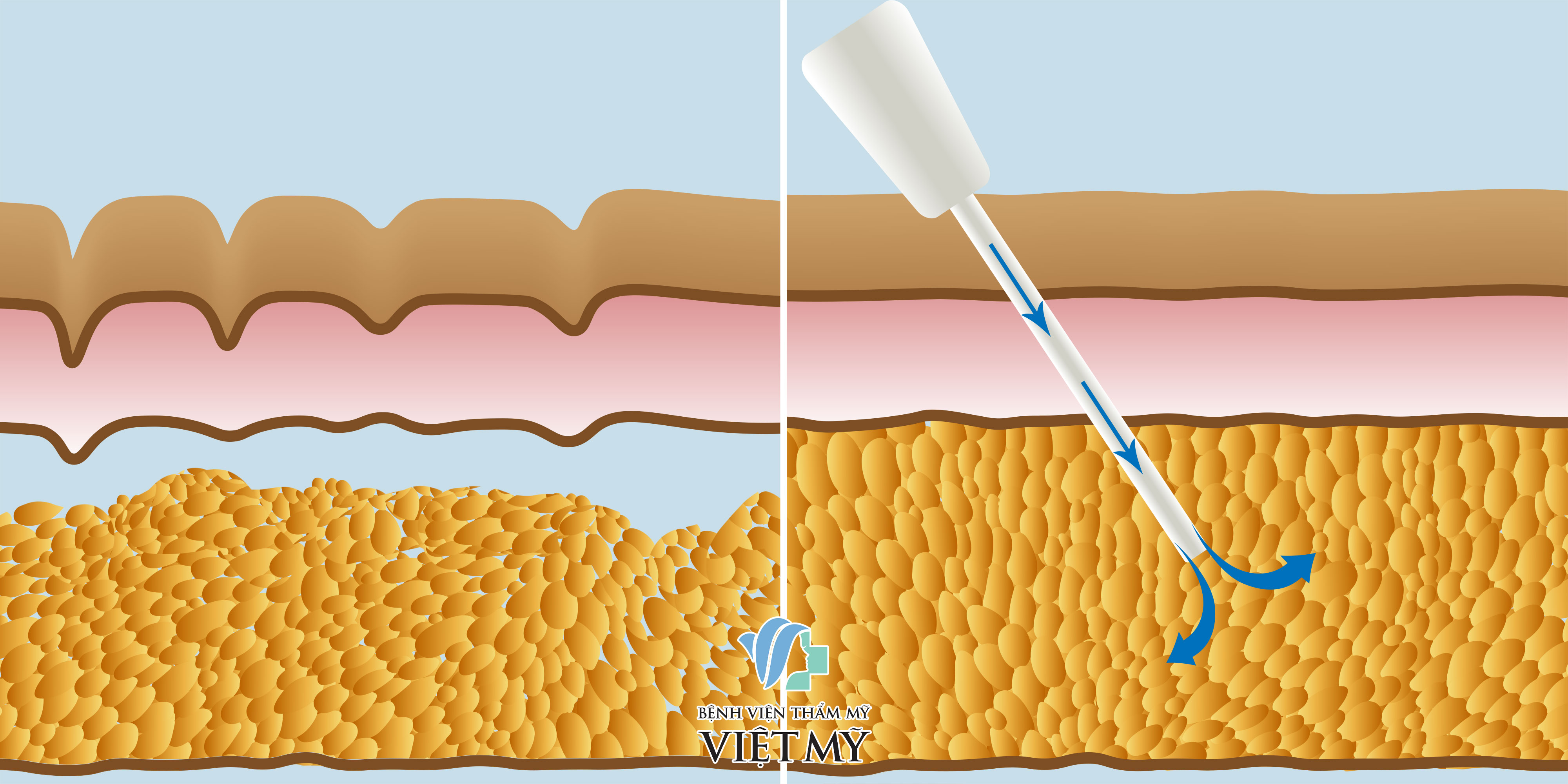 cấy mỡ tự thân giúp làm đầy khu vực điều trị