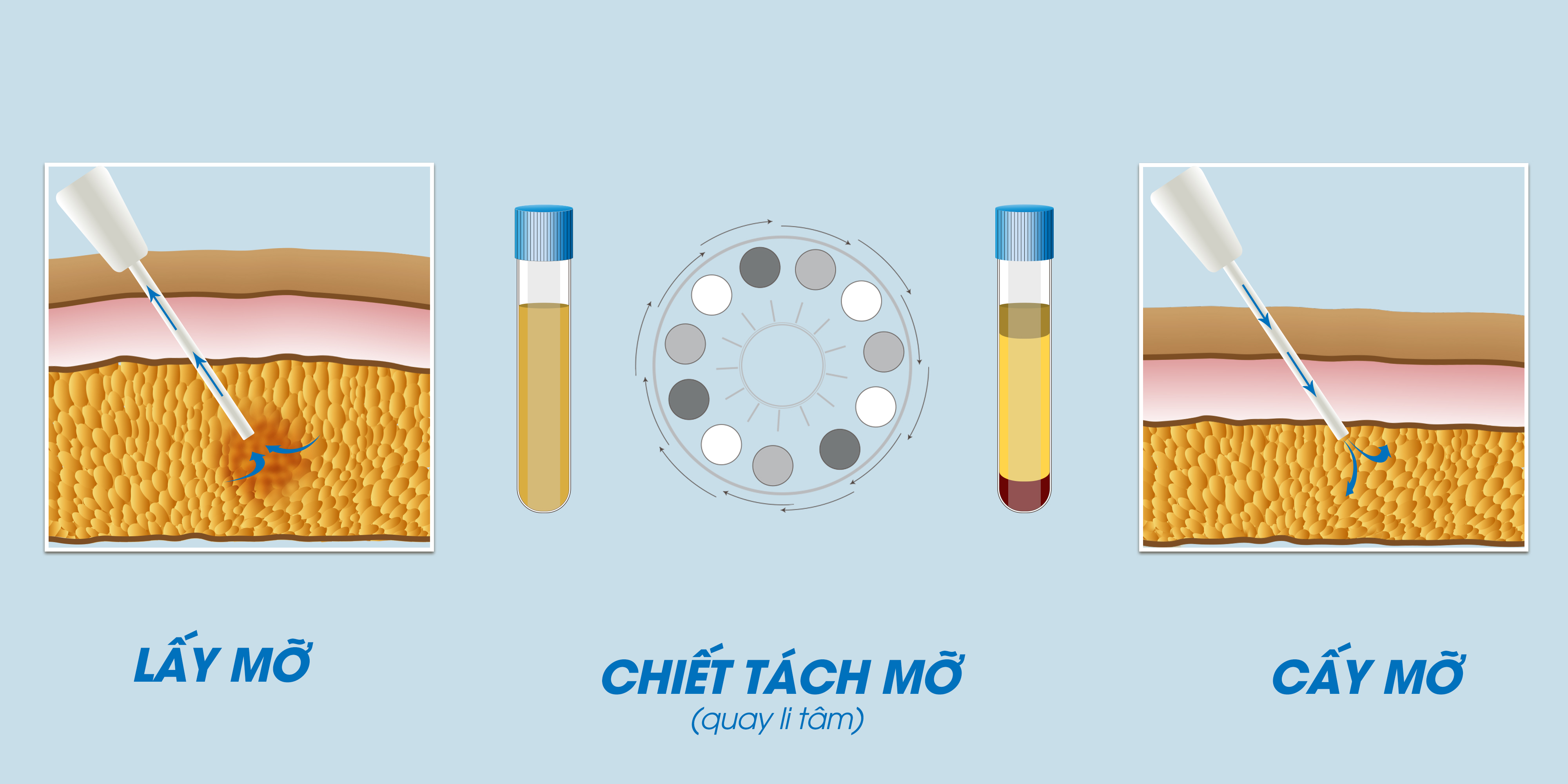 Quy trình điều trị cấy mỡ trẻ hóa khuôn mặt