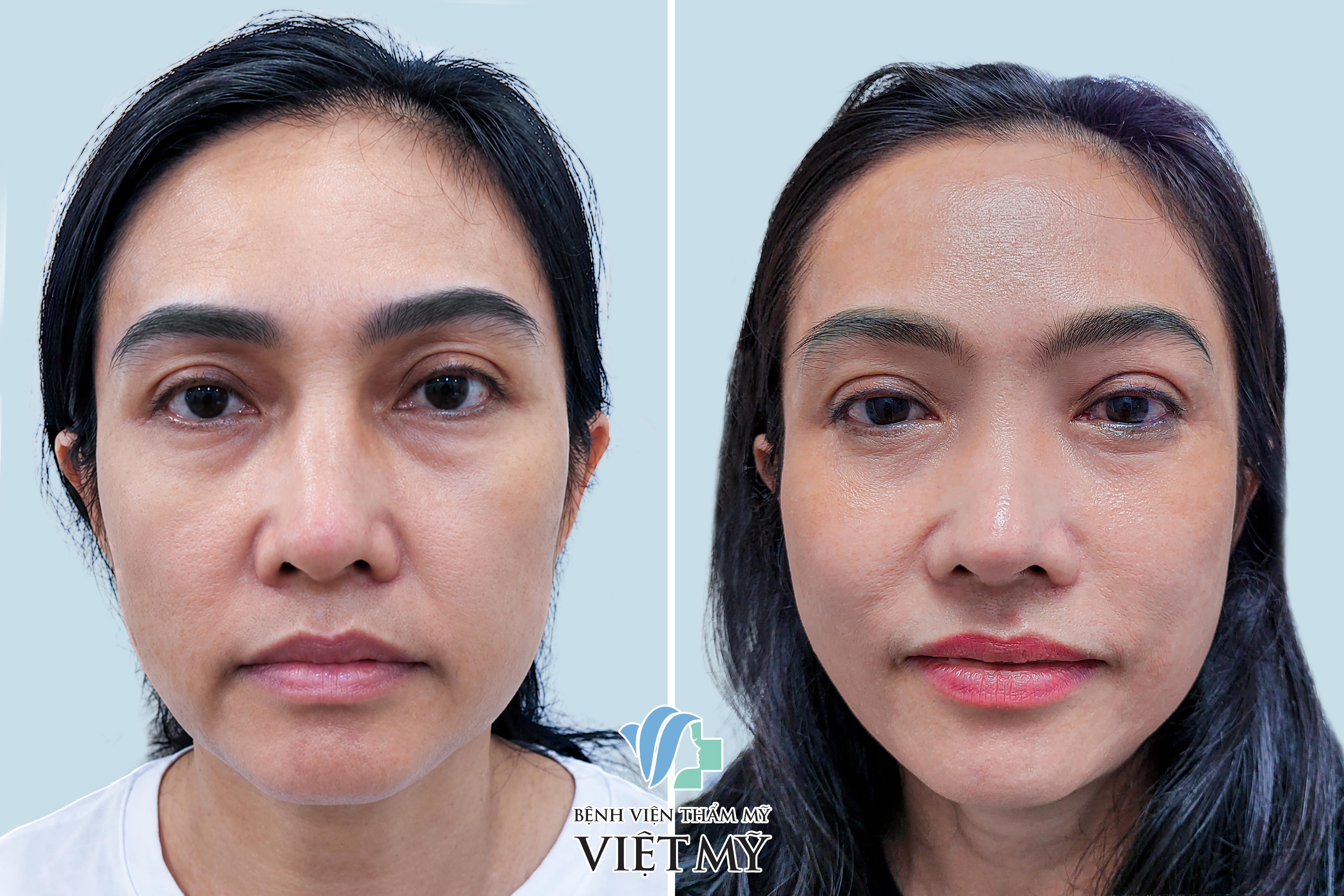 tiêm mỡ hốc mắt