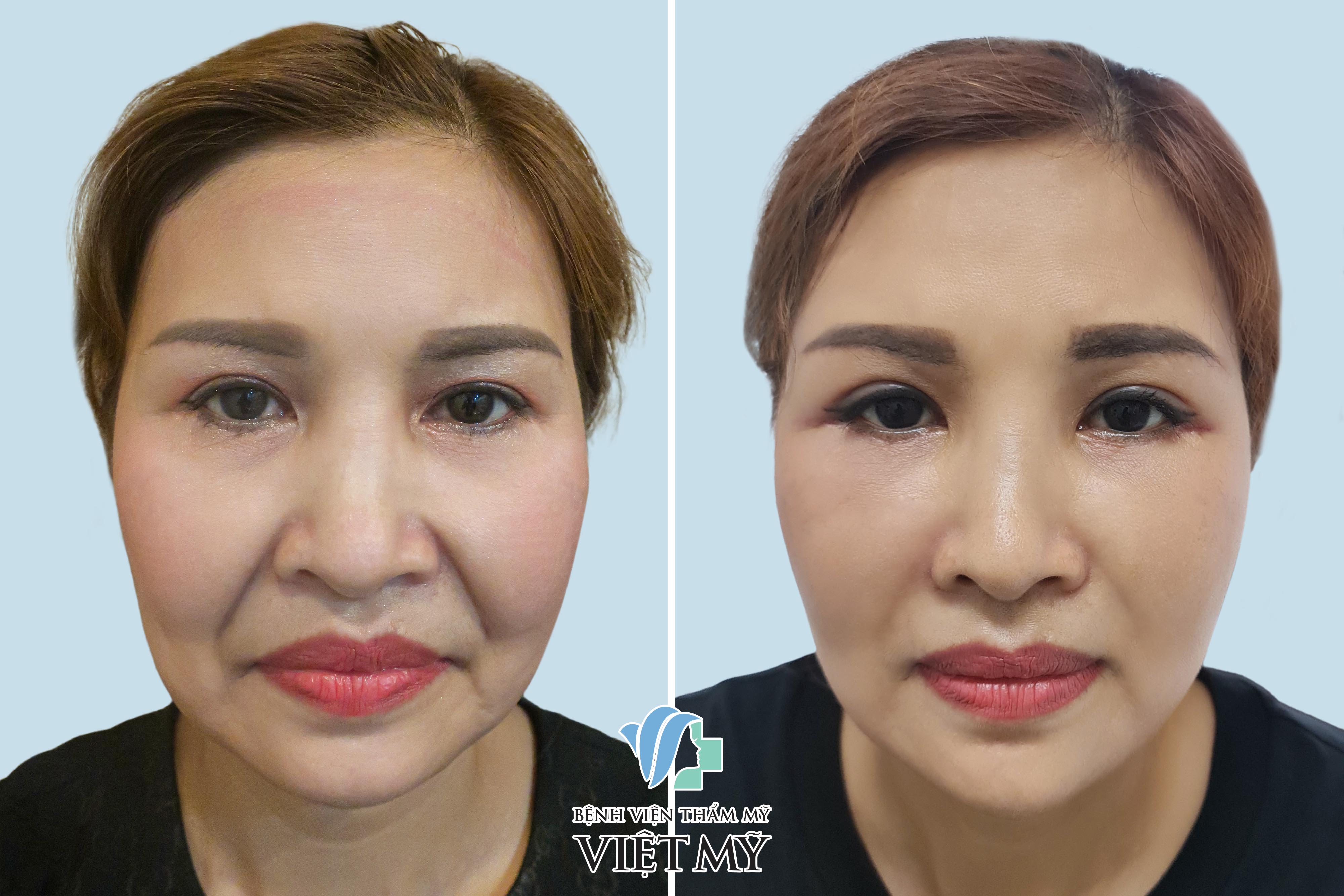 làm đầy rãnh mũi má