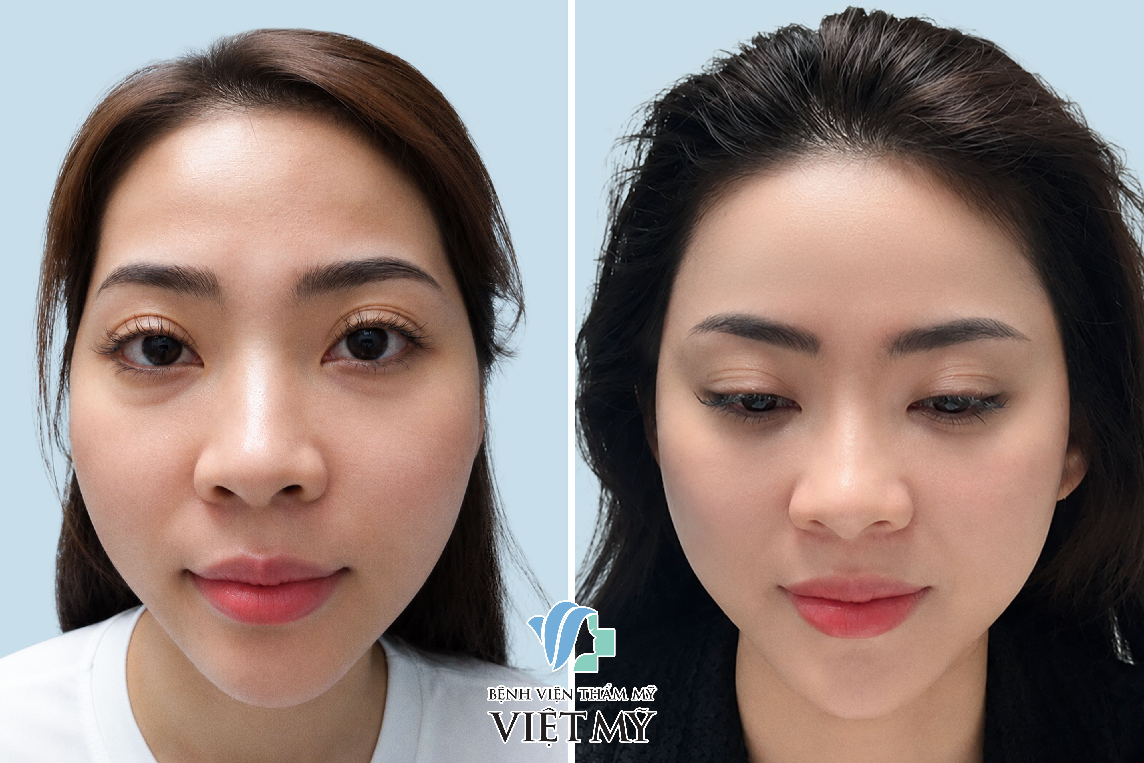 bơm mỡ thái dương