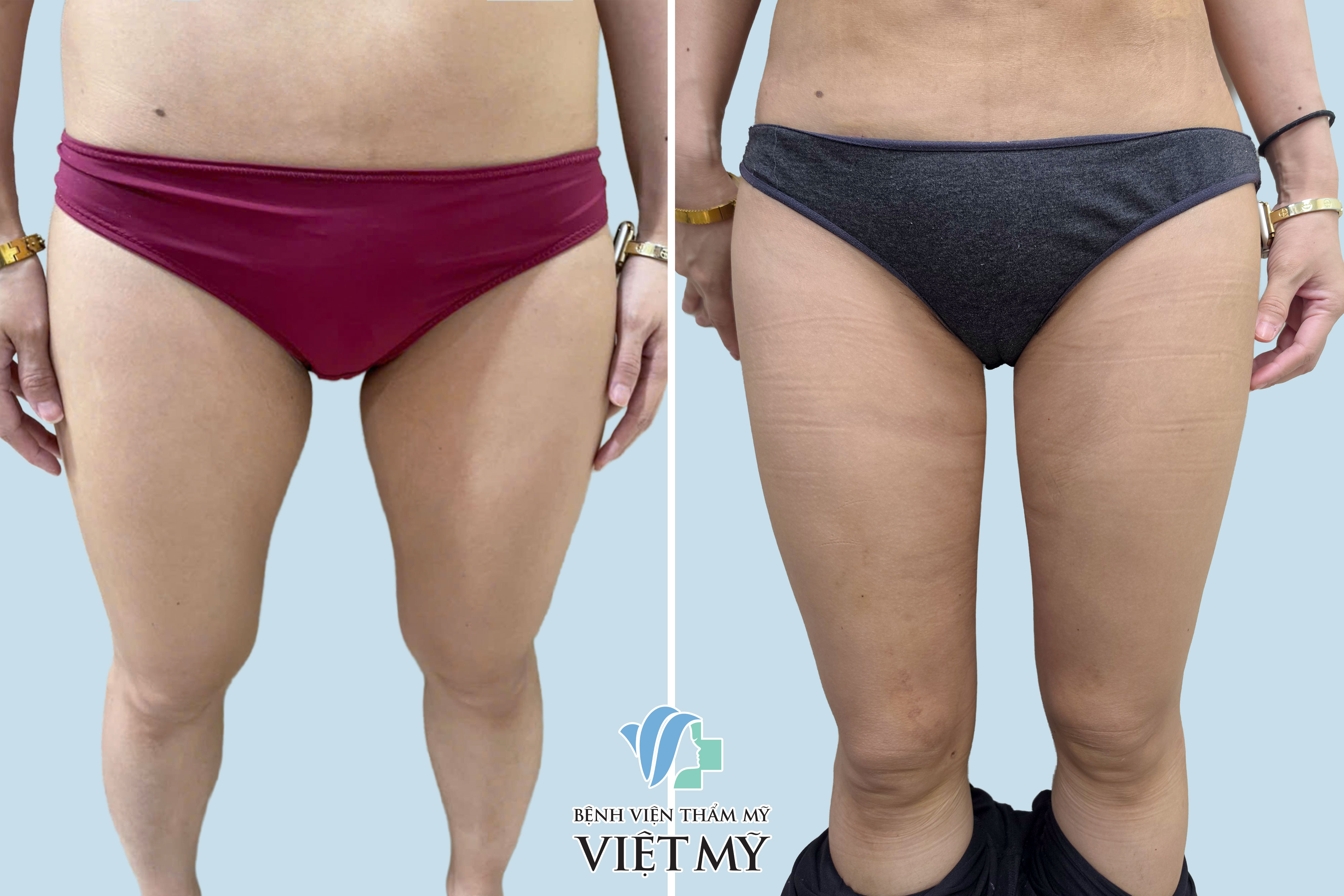 Hình ảnh trước và sau khách hàng hút mỡ gối, đùi, bụng