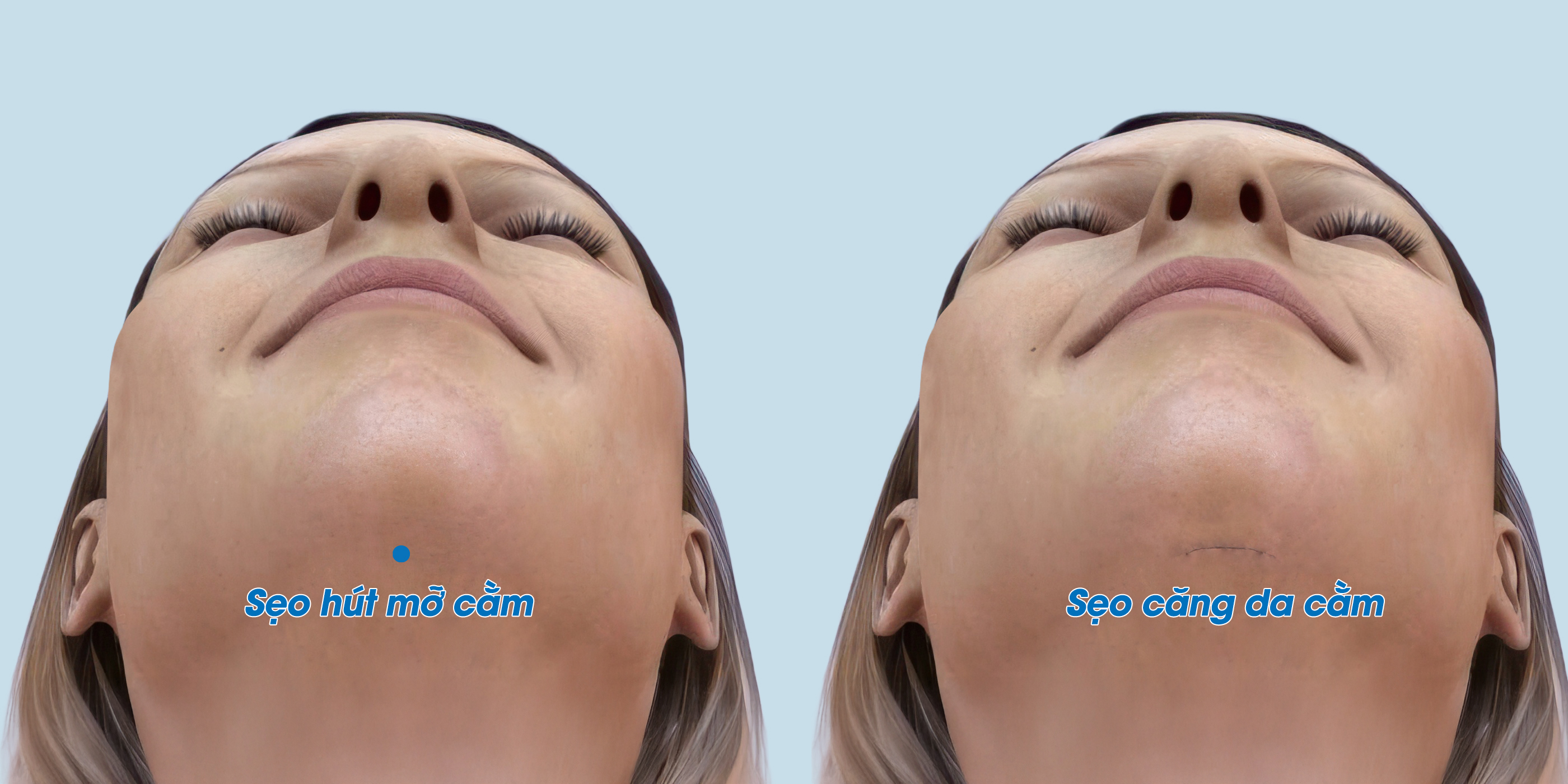 vết mổ ở cằm