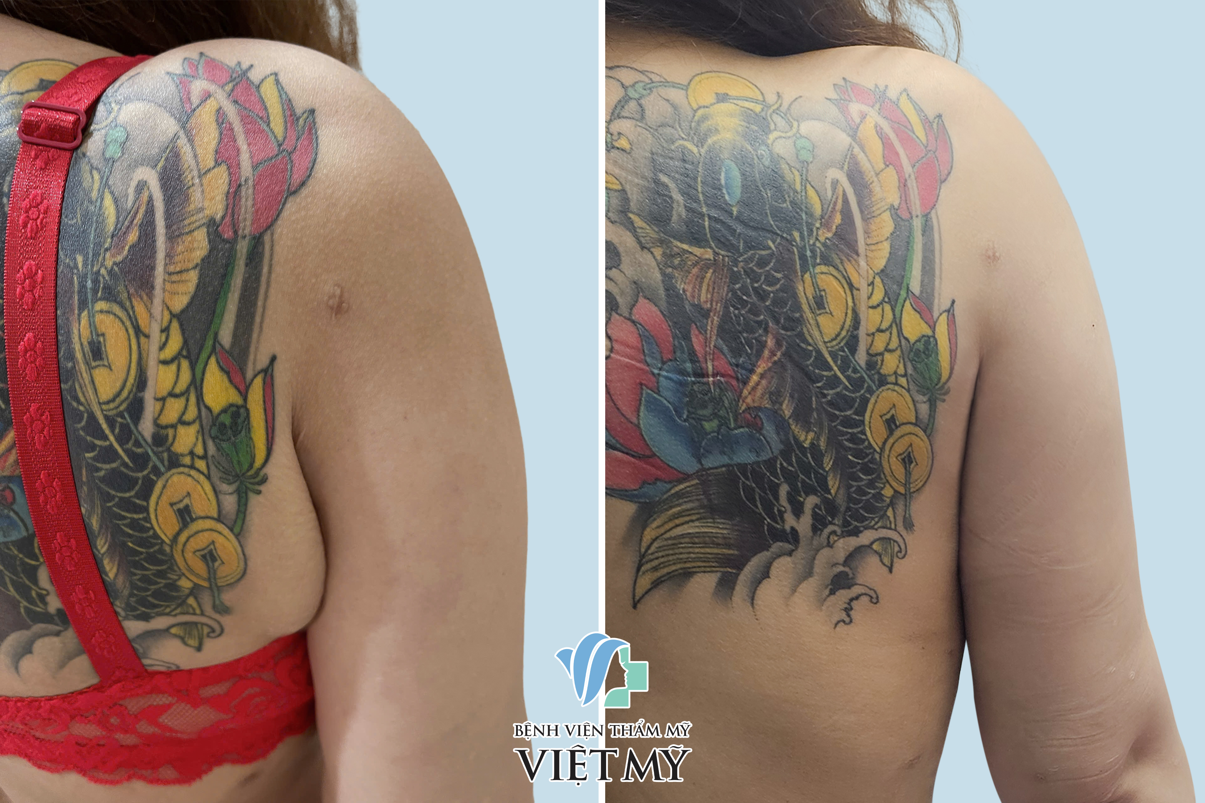 Hình ảnh trước và sau khi khách hàng hút mỡ - căng da tay, nách.