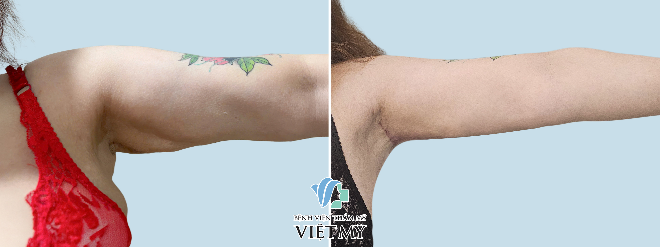 Hình ảnh trước và sau khi khách hàng hút mỡ - căng da tay, nách.