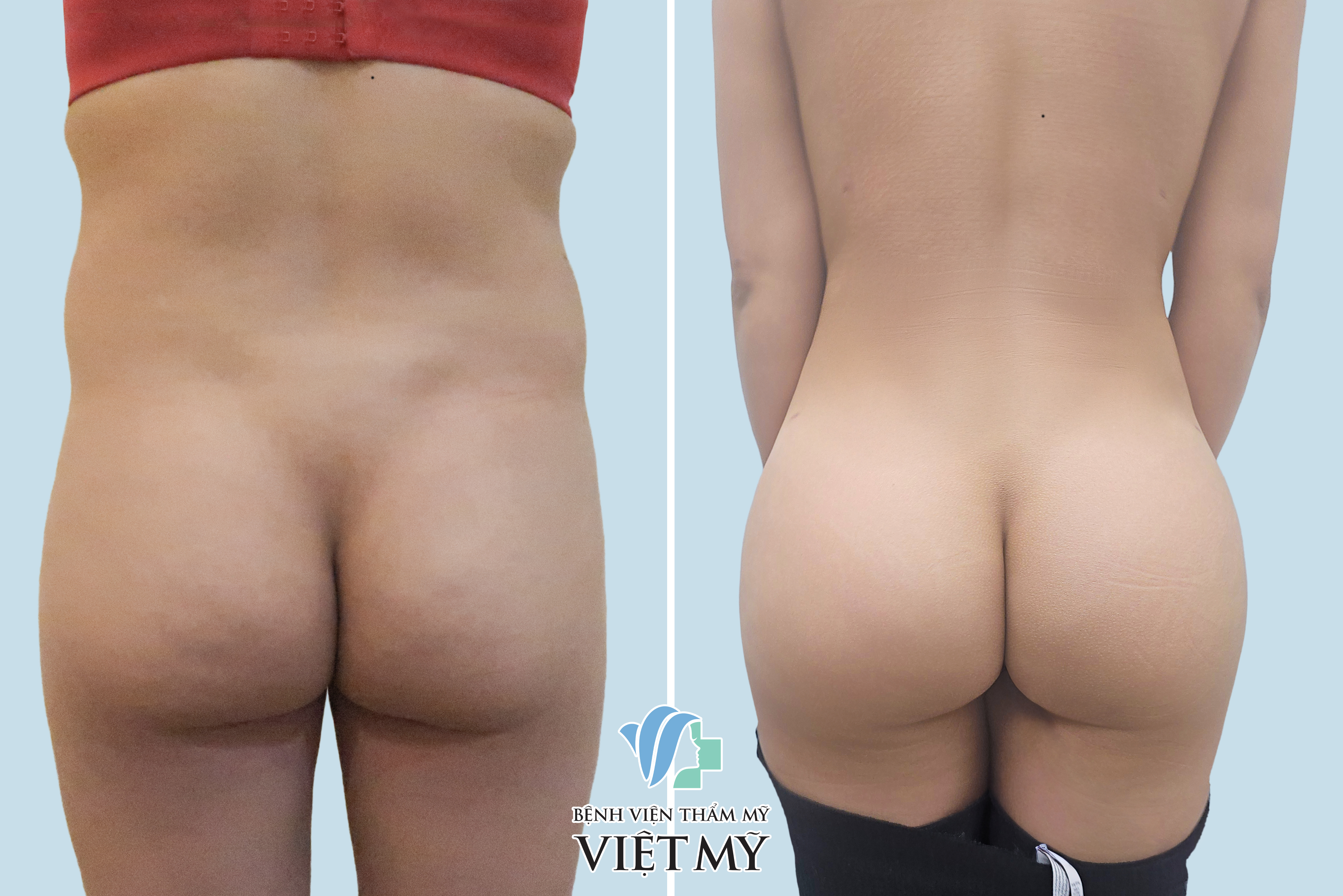 khách hàng trước sau hút mỡ