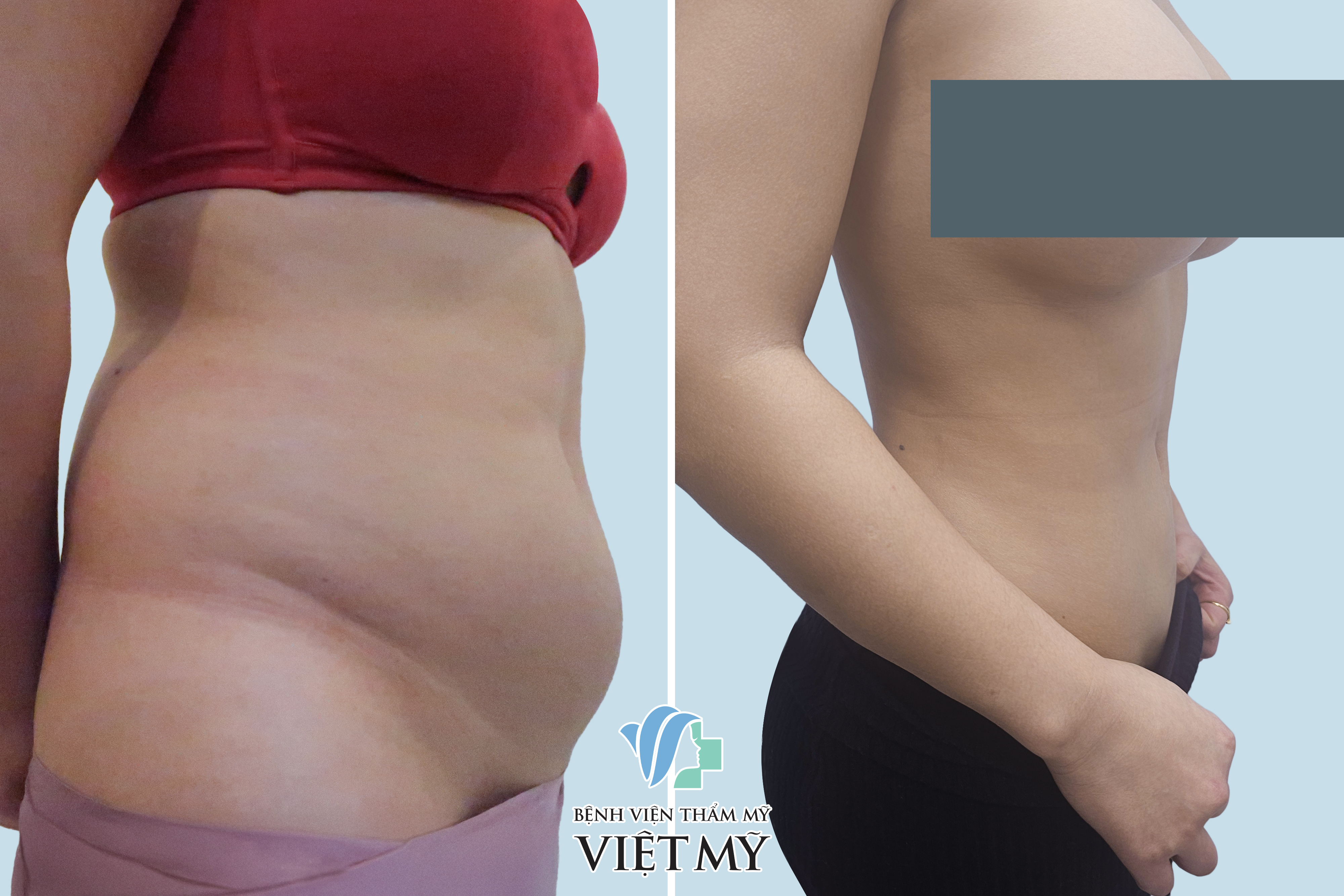 khách hàng trước sau hút mỡ