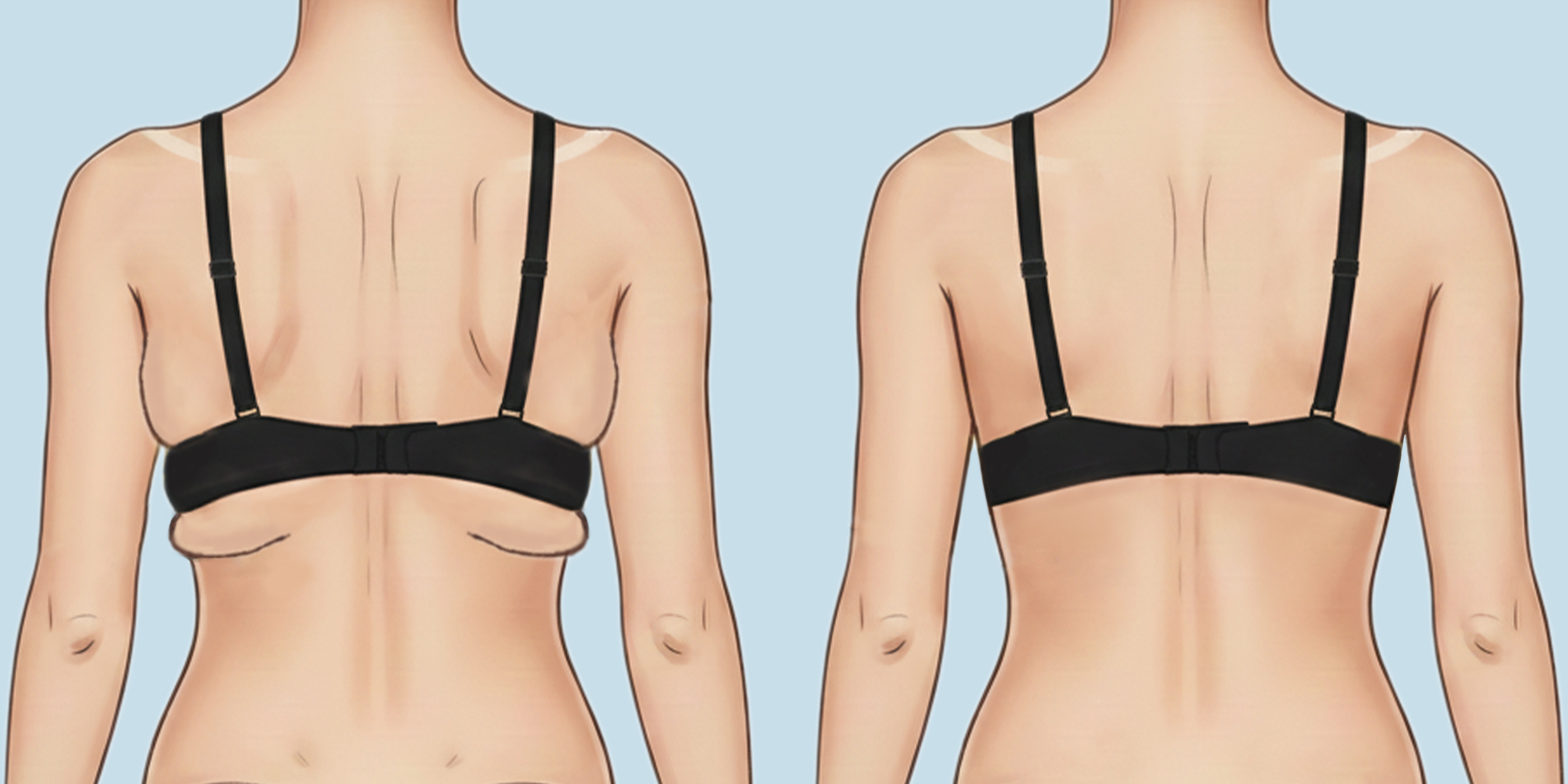 Mô phỏng lợi ích của phẫu thuật hút mỡ lưng, nách