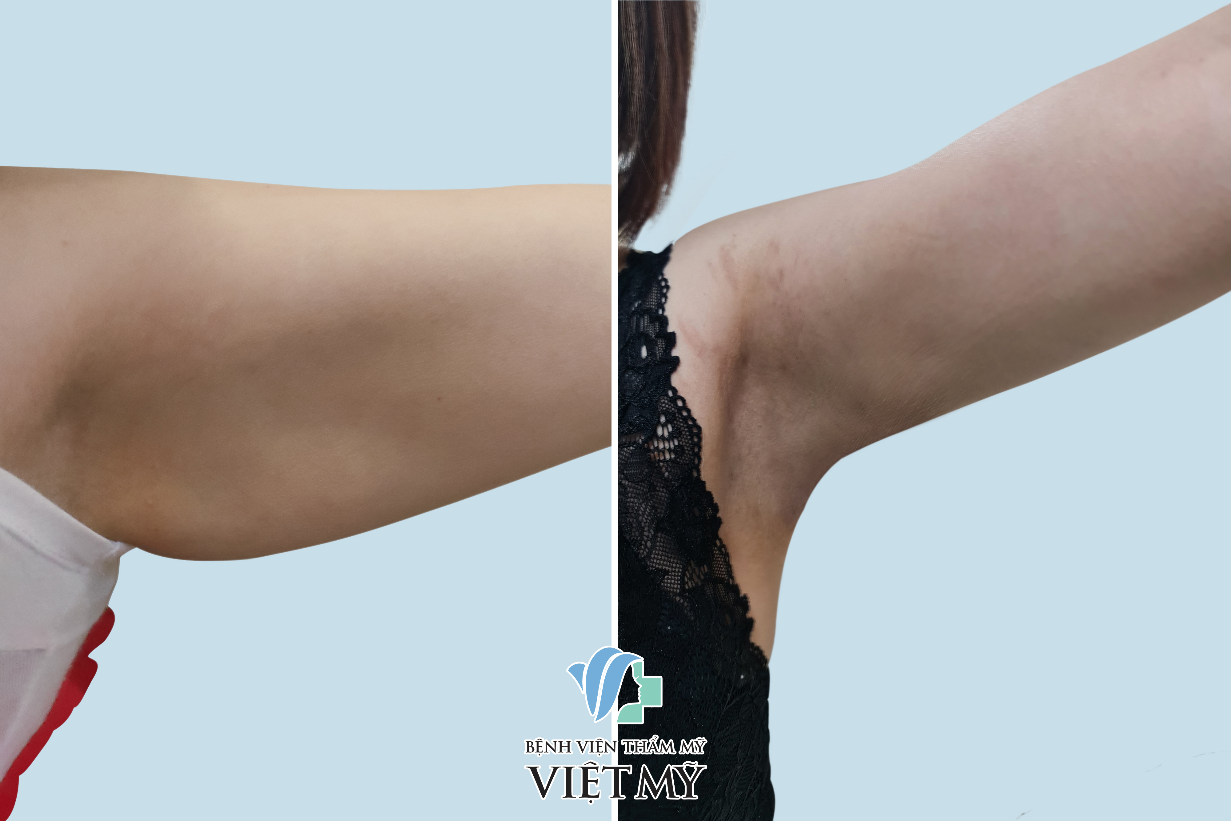 Hình ảnh trước và sau khi khách hàng hút mỡ tay, nách.