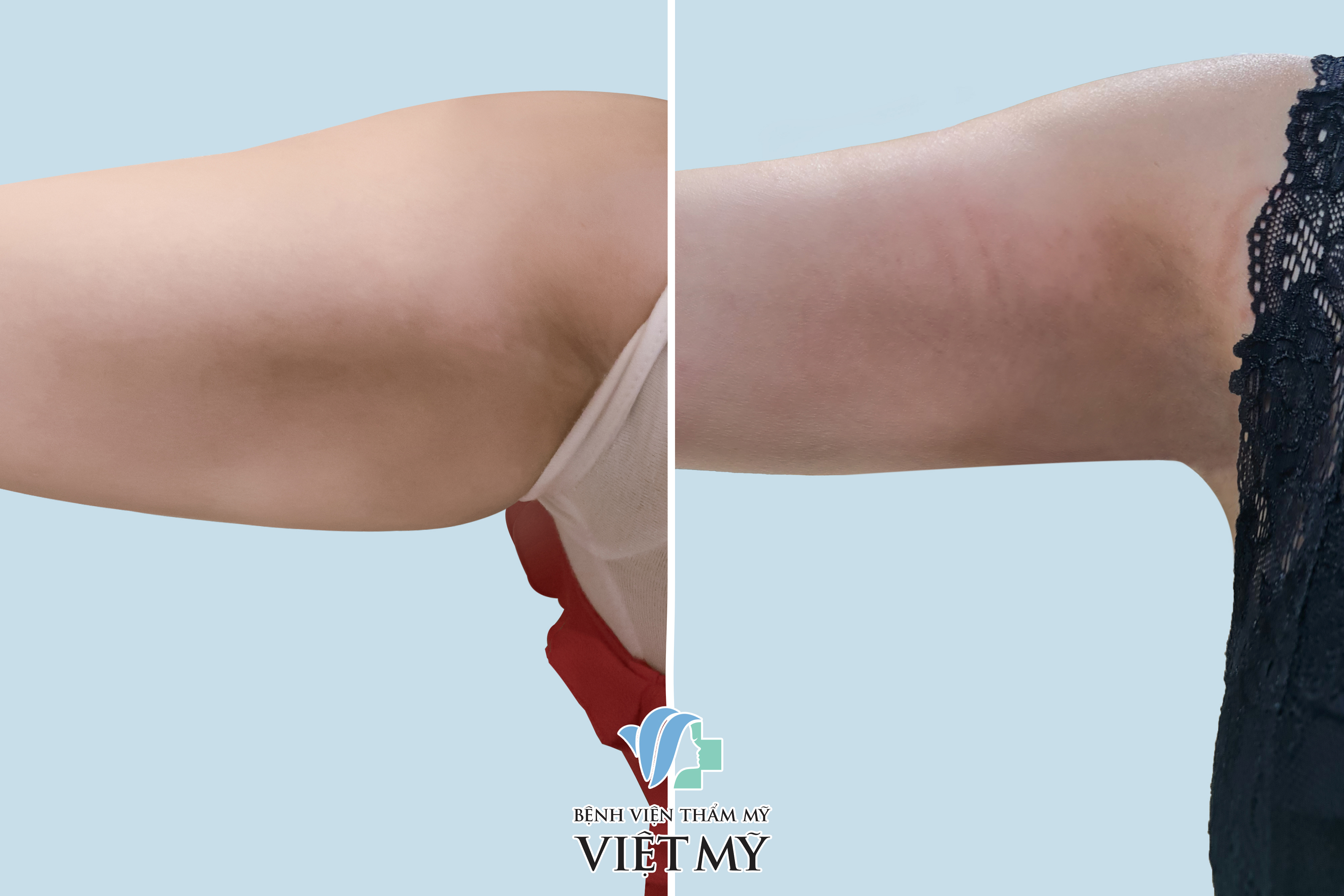 Hình ảnh trước và sau khi khách hàng hút mỡ tay, nách.