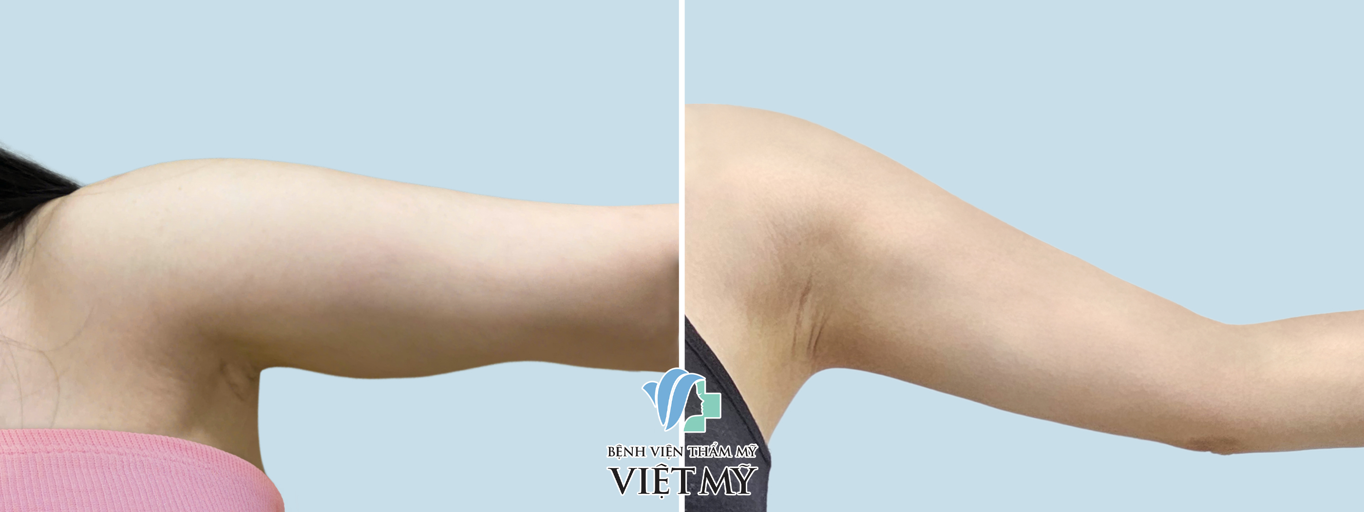 Hình ảnh trước và sau khi khách hàng hút mỡ tay.