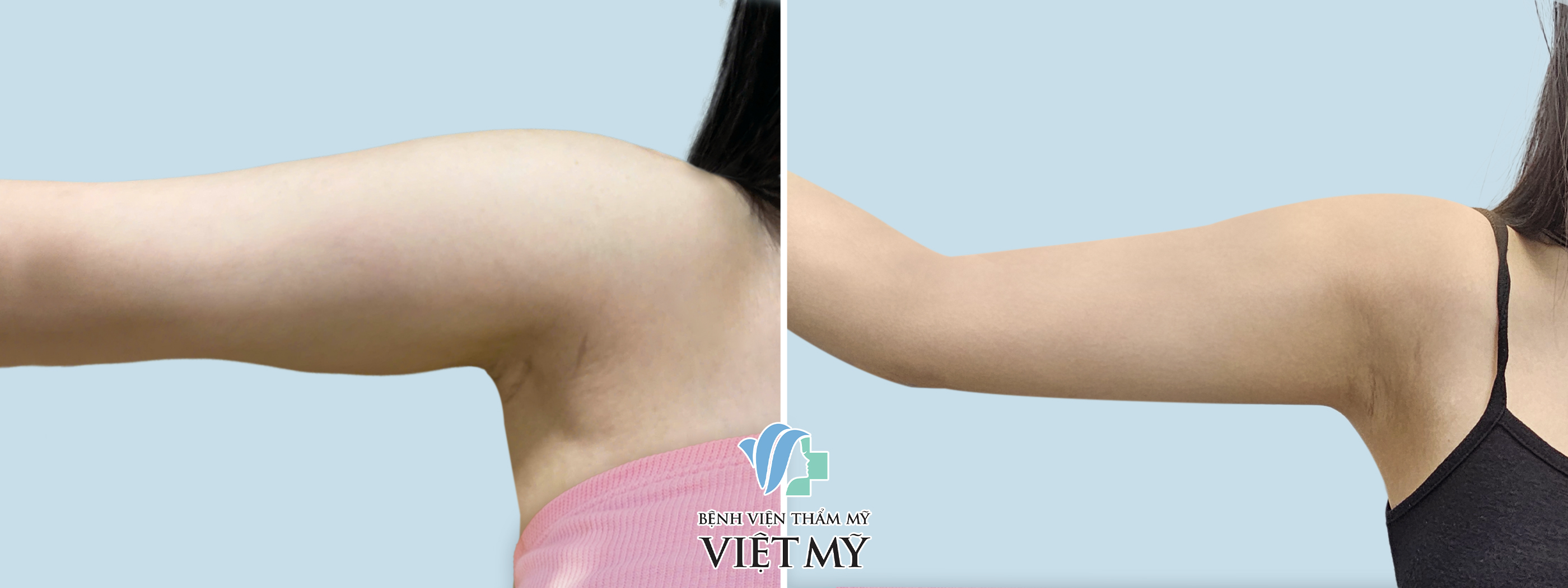 Hình ảnh trước và sau khi khách hàng hút mỡ tay.