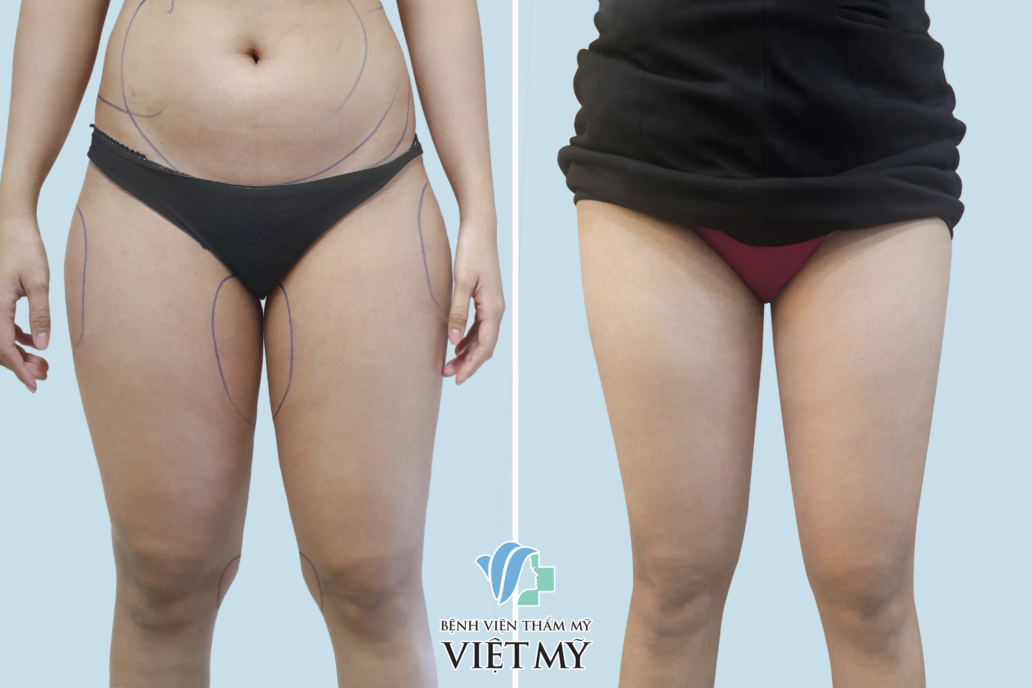 khách hàng hút mỡ bụng, đùi