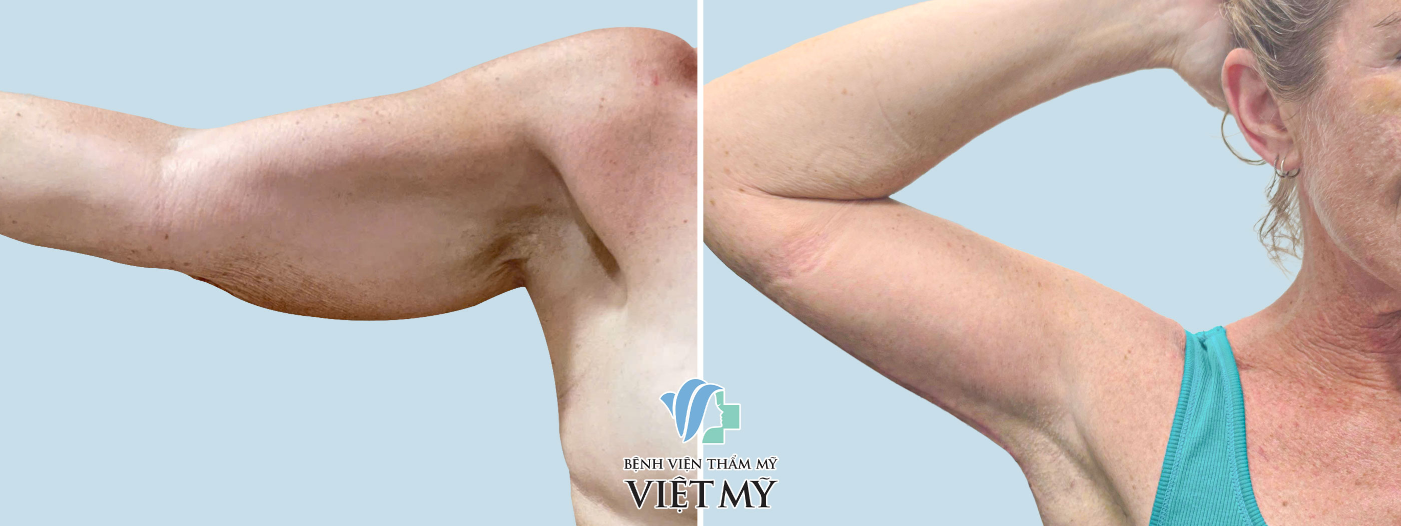 Hình ảnh trước và sau khi khách hàng hút mỡ tay, nách.