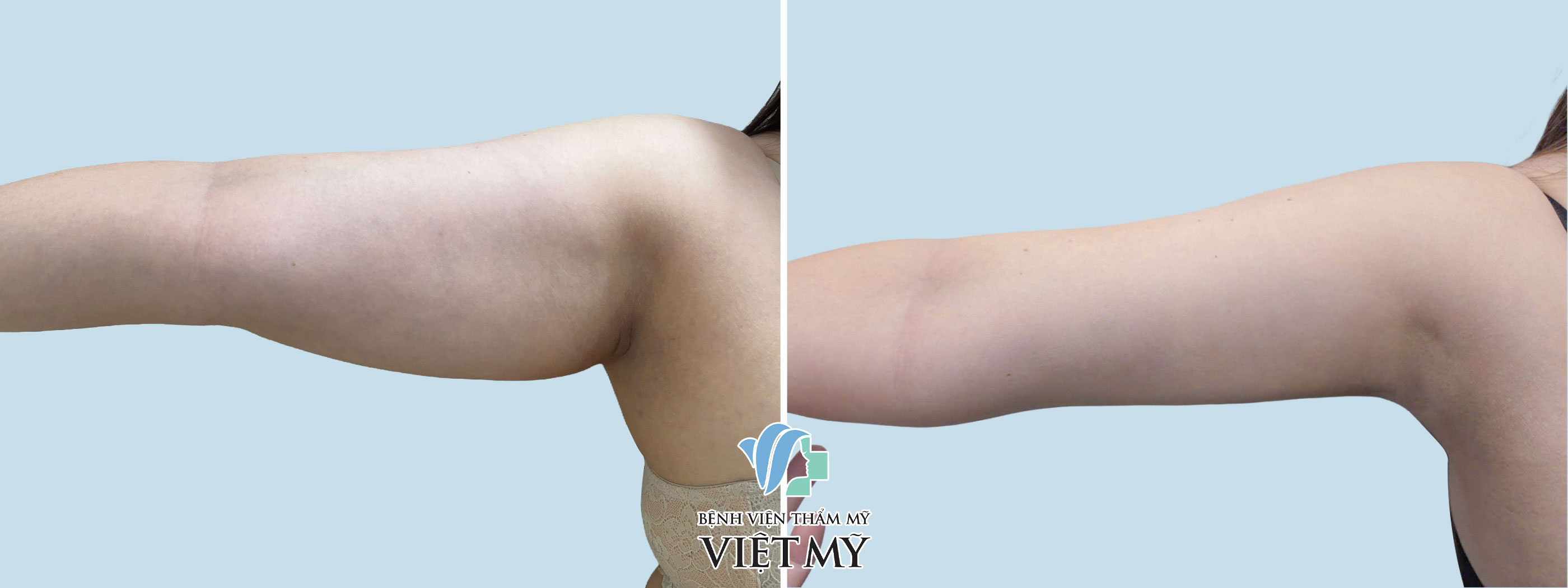 Hình ảnh trước và sau khi khách hàng hút mỡ tay, nách.