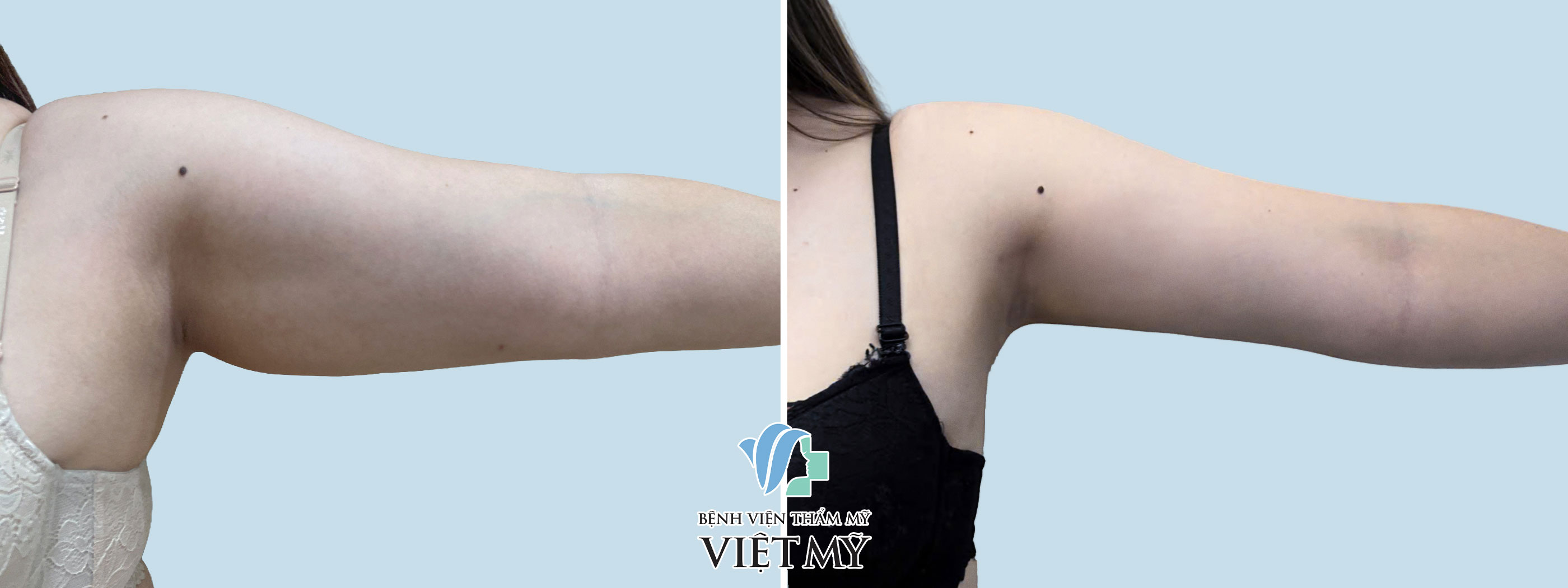 Hình ảnh trước và sau khi khách hàng hút mỡ tay, nách.