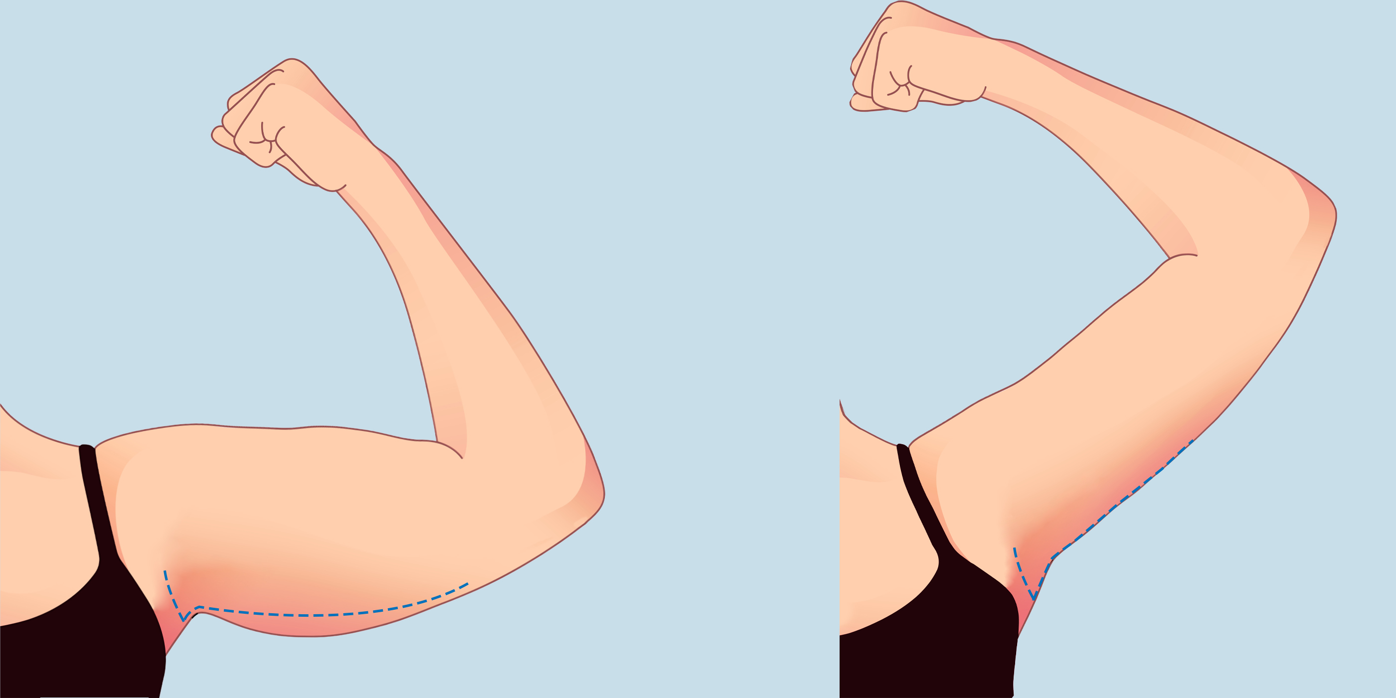 Đường mổ nằm ở cạnh dưới của cánh tay và hố nách.