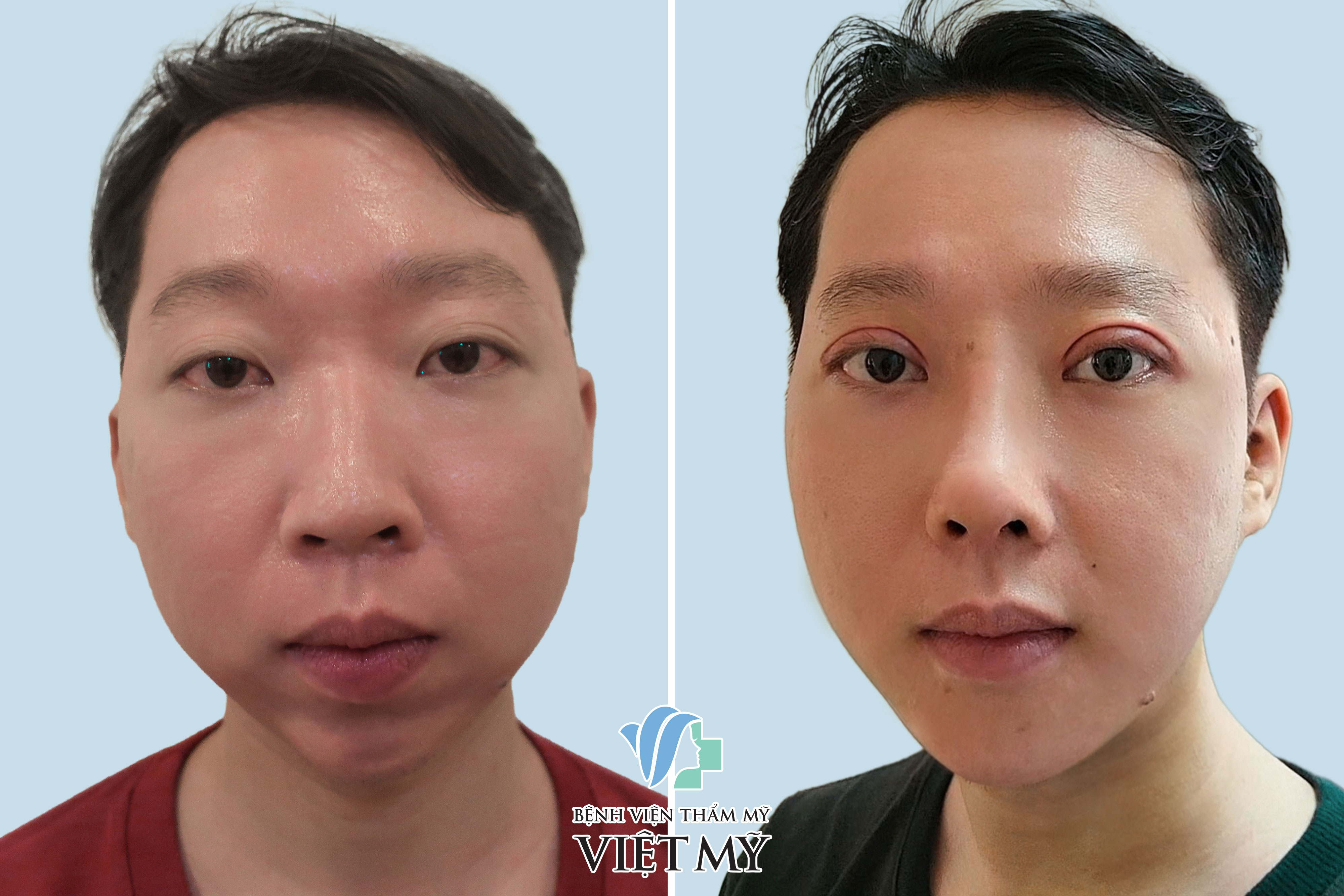 nâng cằm sau 1 tuần