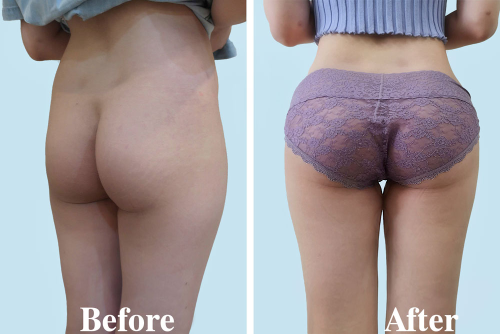 nâng mông chảy xệ