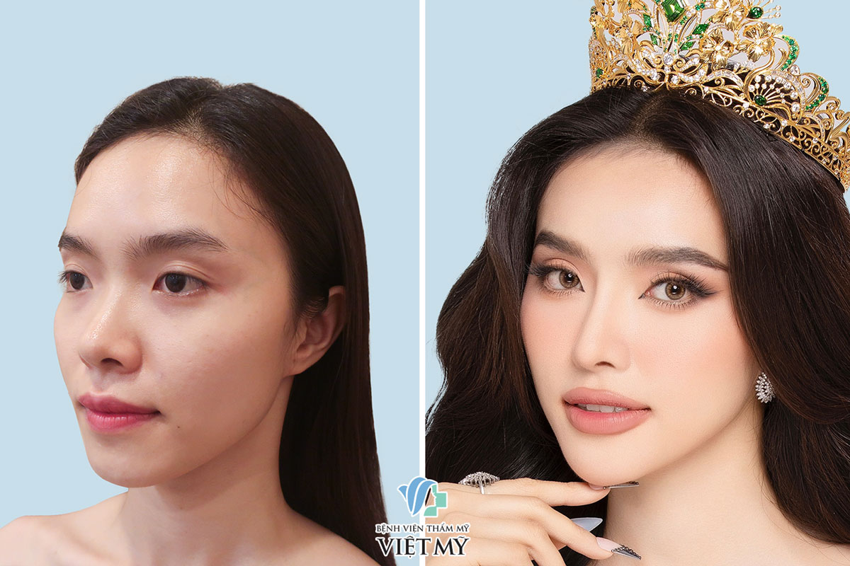 Image Hạnh Nguyên image beautiful image beautiful image beautiful - S Line Rhinoplasty - Doctor Chiem Quoc Thai