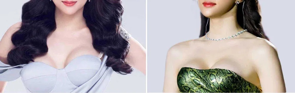 Hoa hậu Hương Giang nâng ngực dưới tuyến tại Thái Lan