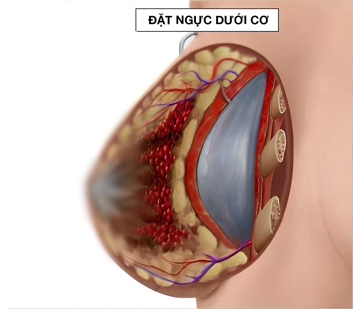 vị trí đặt túi dưới cơ