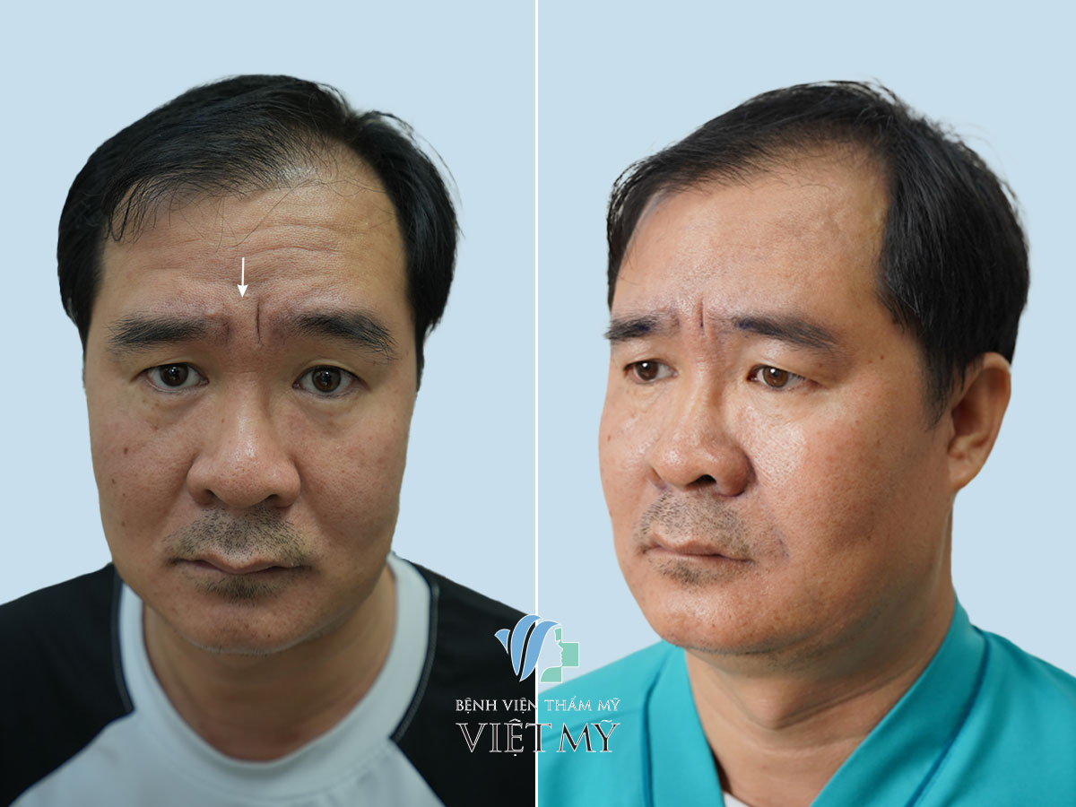 Xoá nhăn cau mày: Cách giảm thiểu và ngăn ngừa nếp nhăn giữa hai chân mày