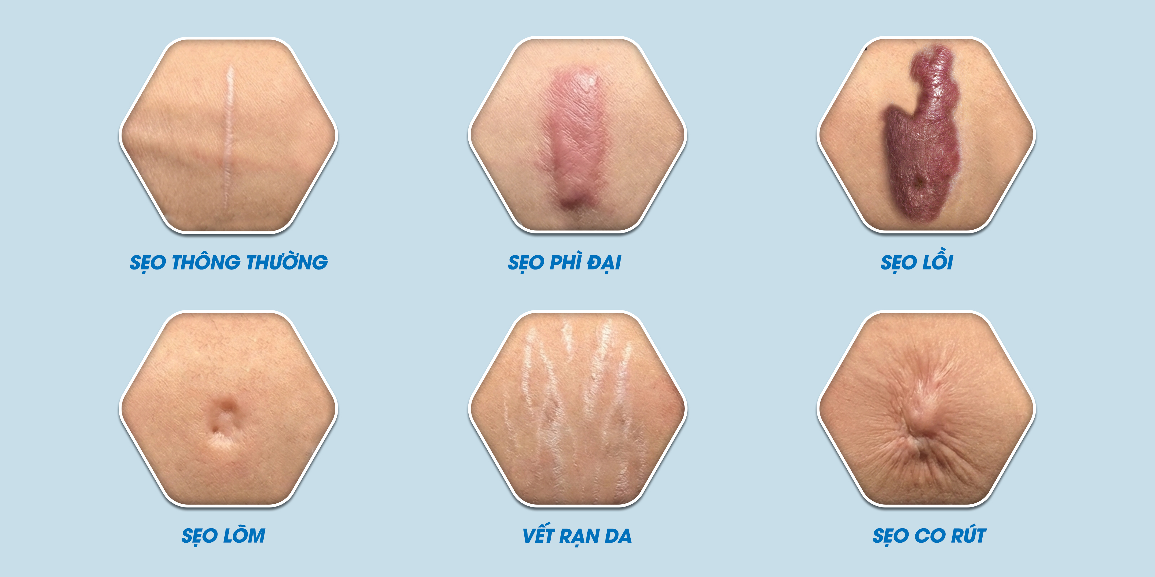 Một số loại sẹo xấu cần điều trị