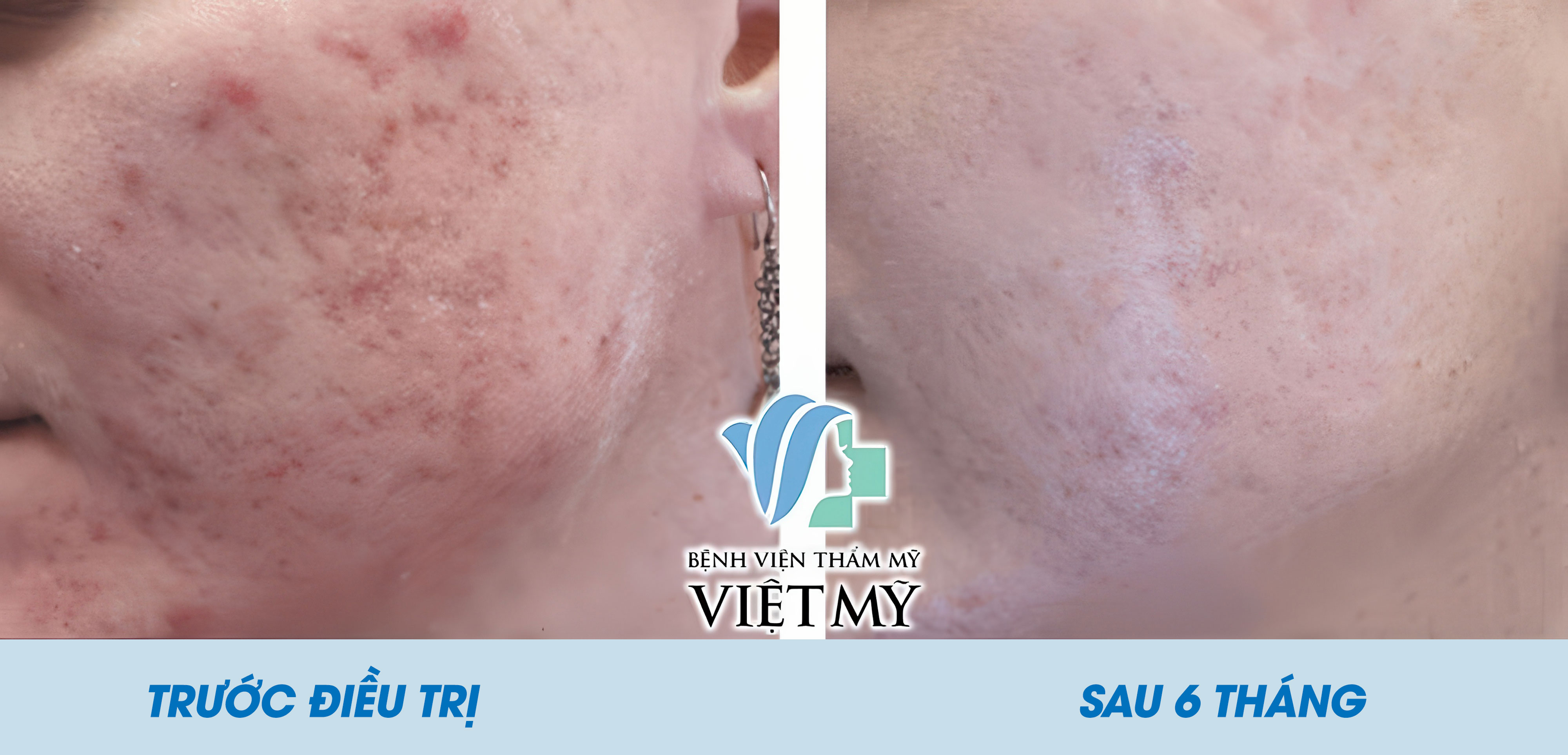 Hình ảnh khách hàng trước và sau điều trị sẹo