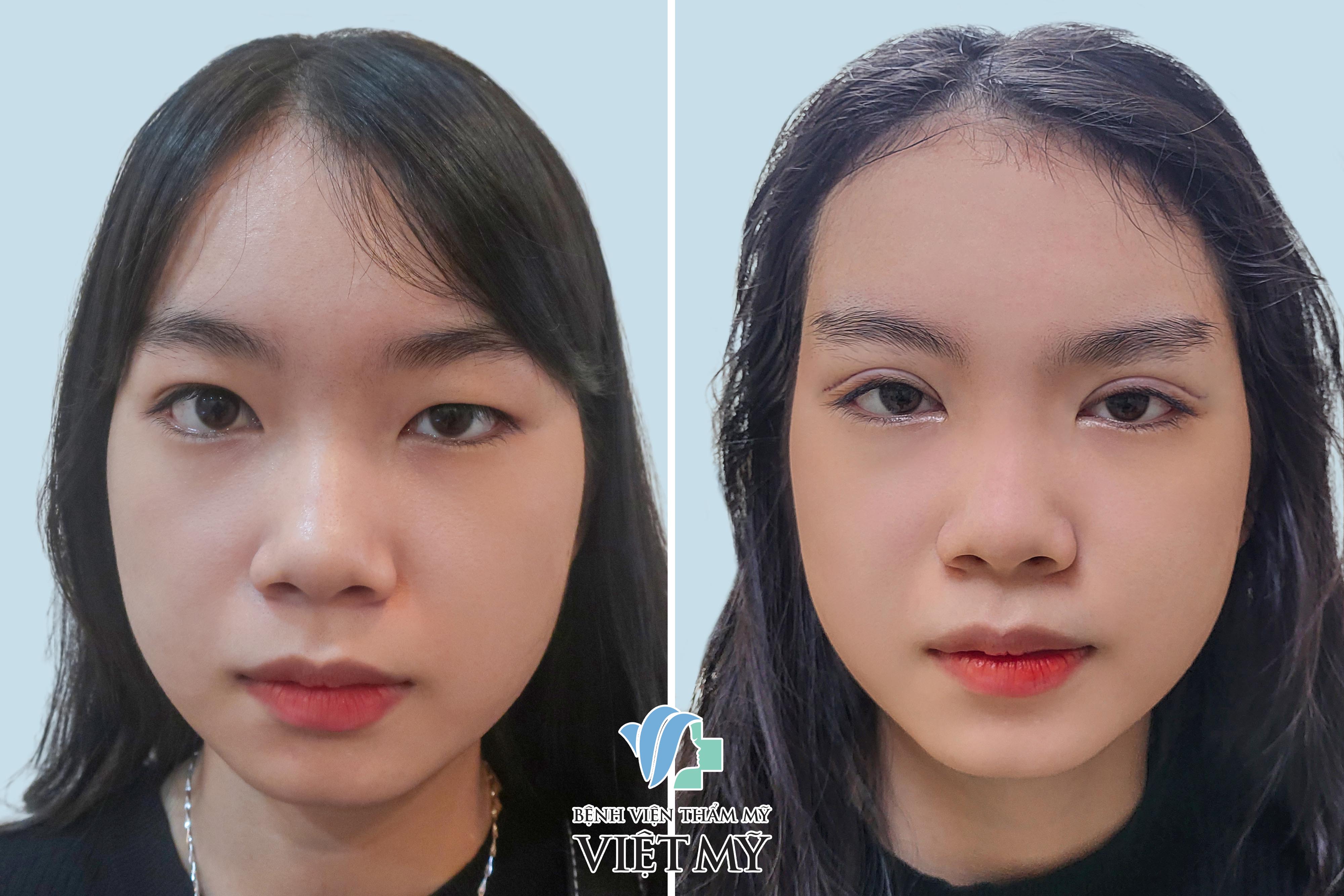 khách hàng cắt mí mắt