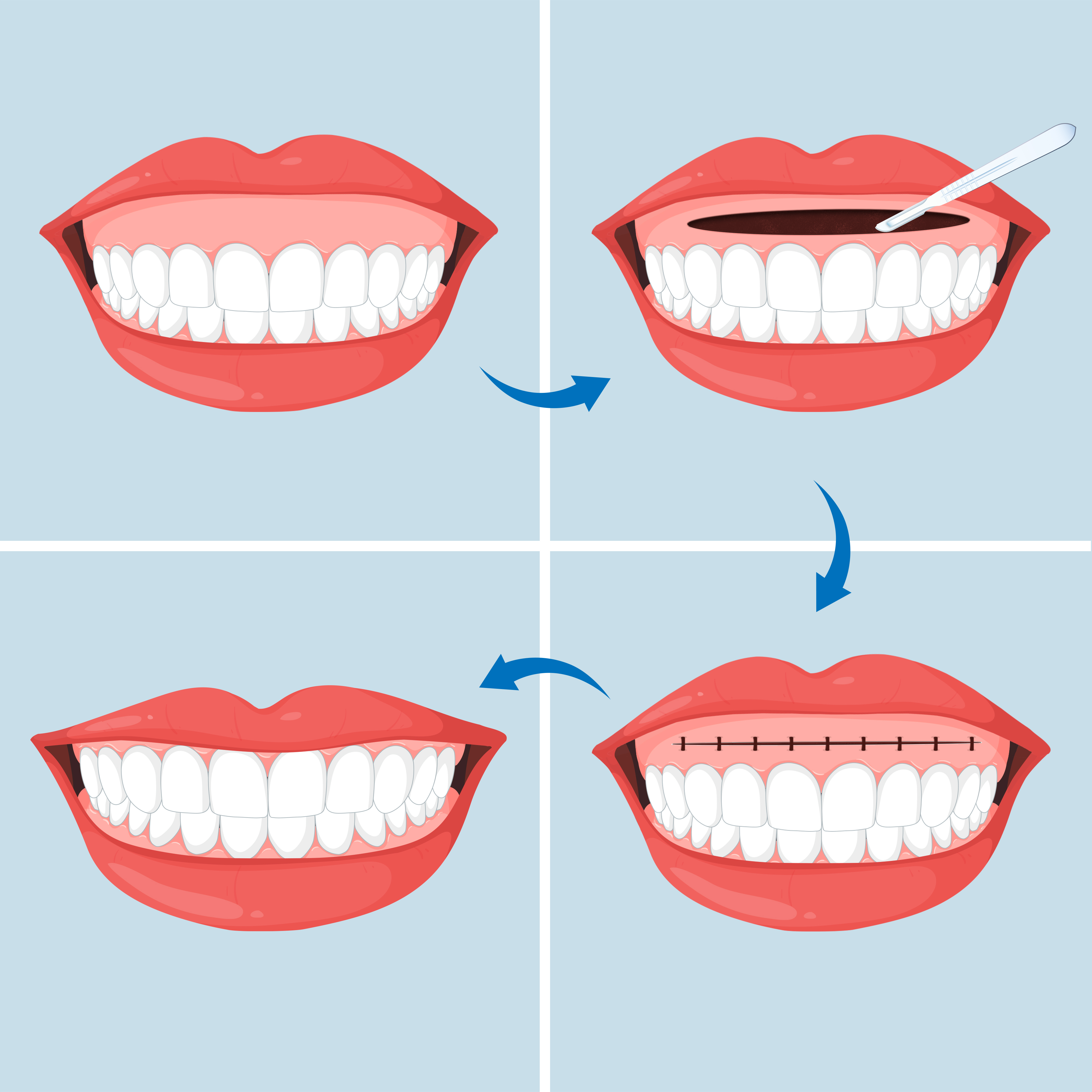 Hình minh họa phẫu thuật kéo dài môi trên