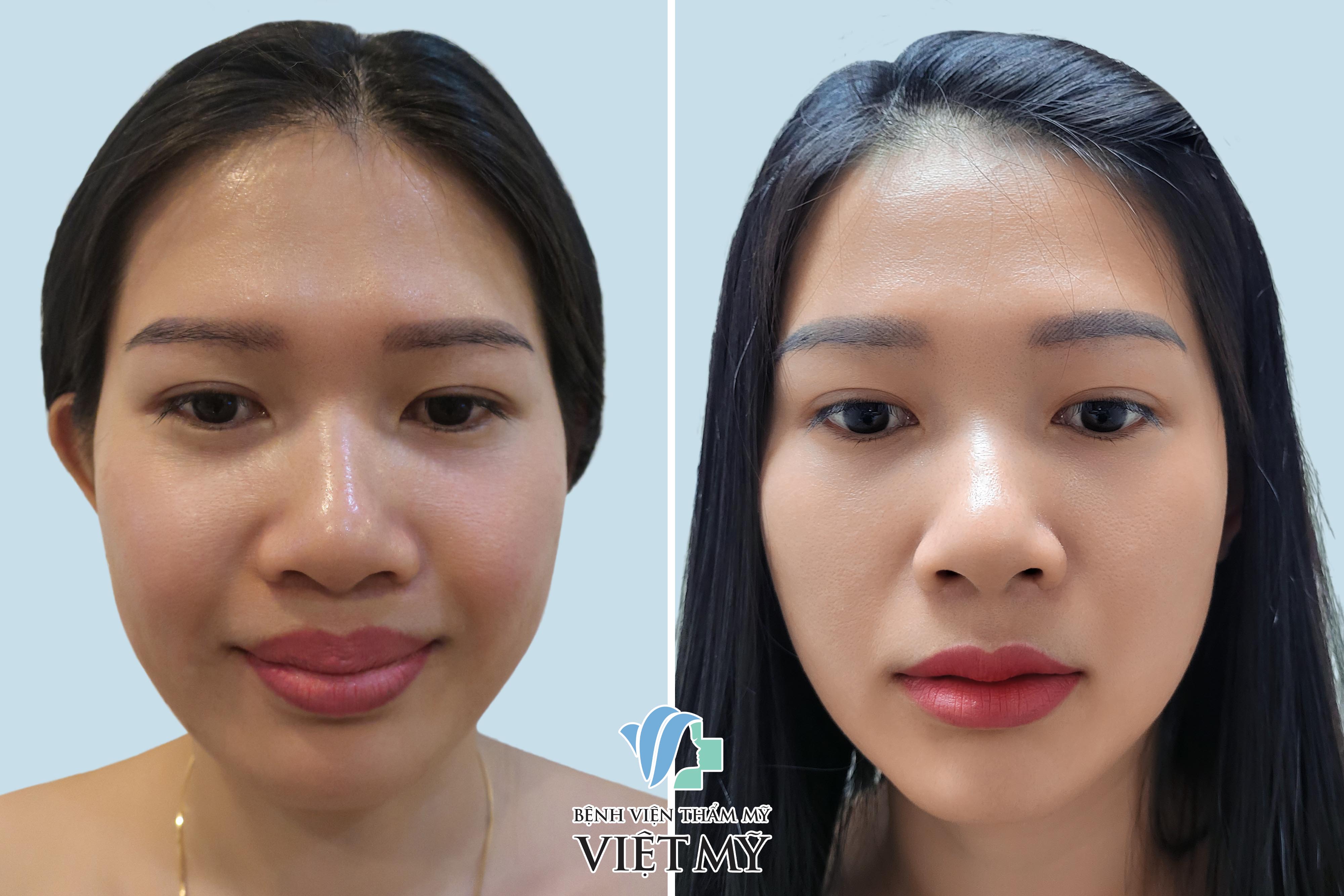 cắt mỏng môi trên và tạo hình môi hạt lựu