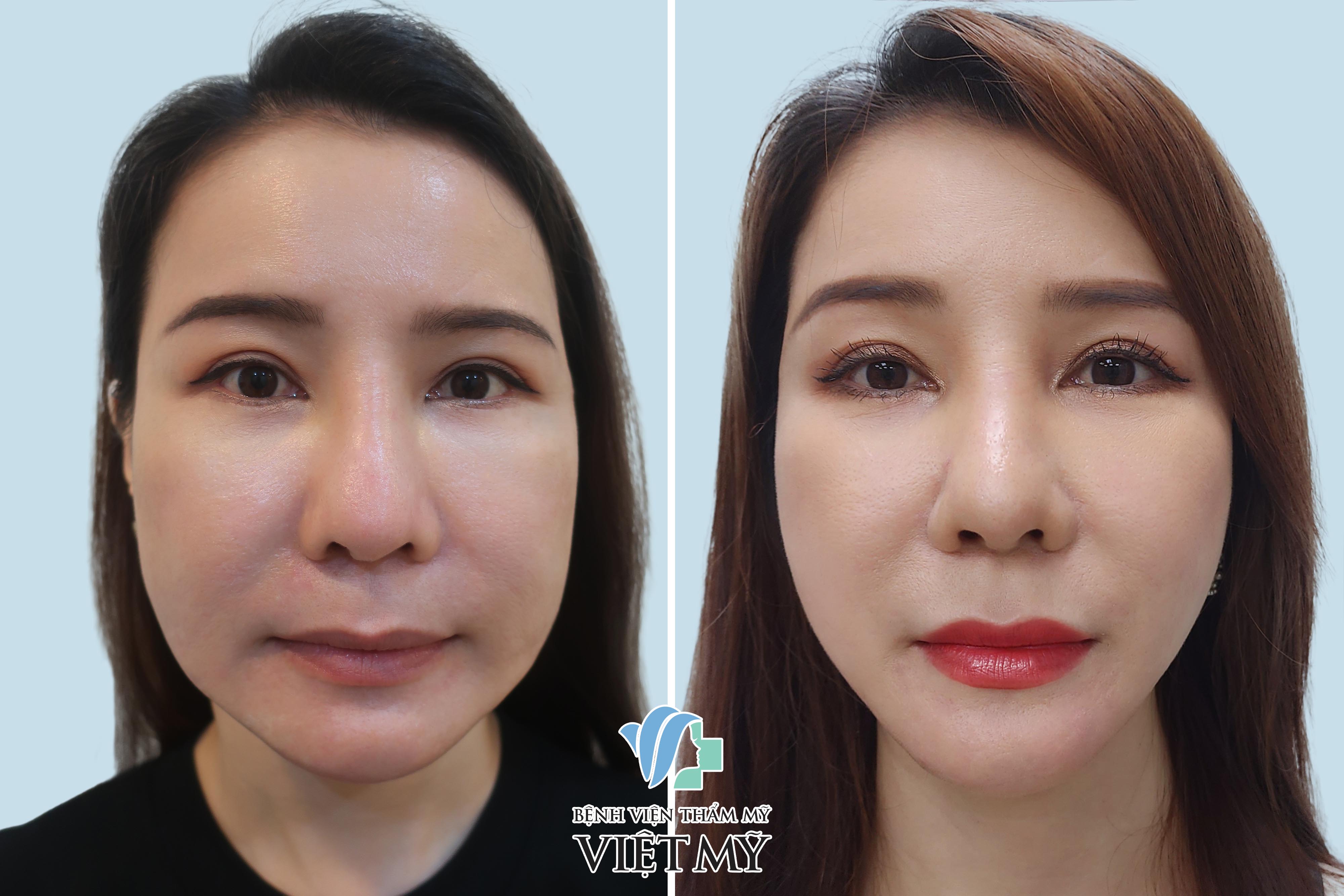 gọt góc hàm