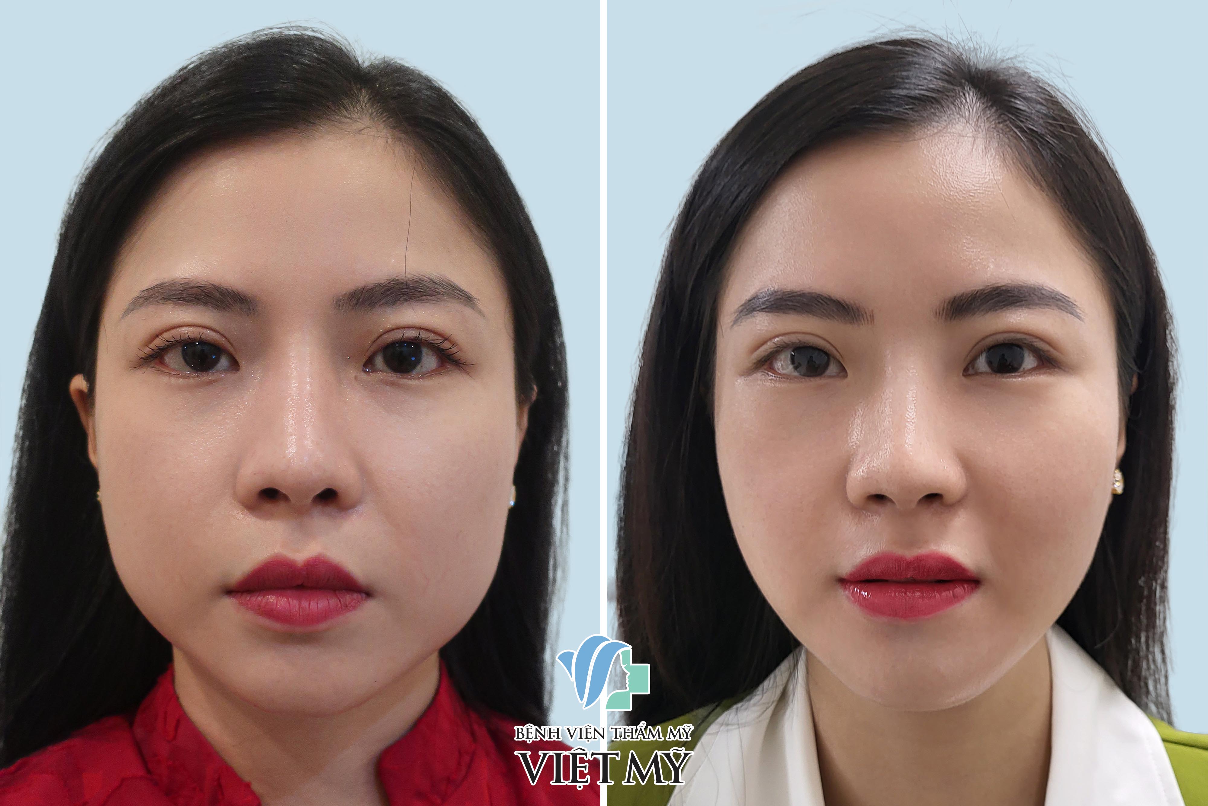 gọt góc hàm